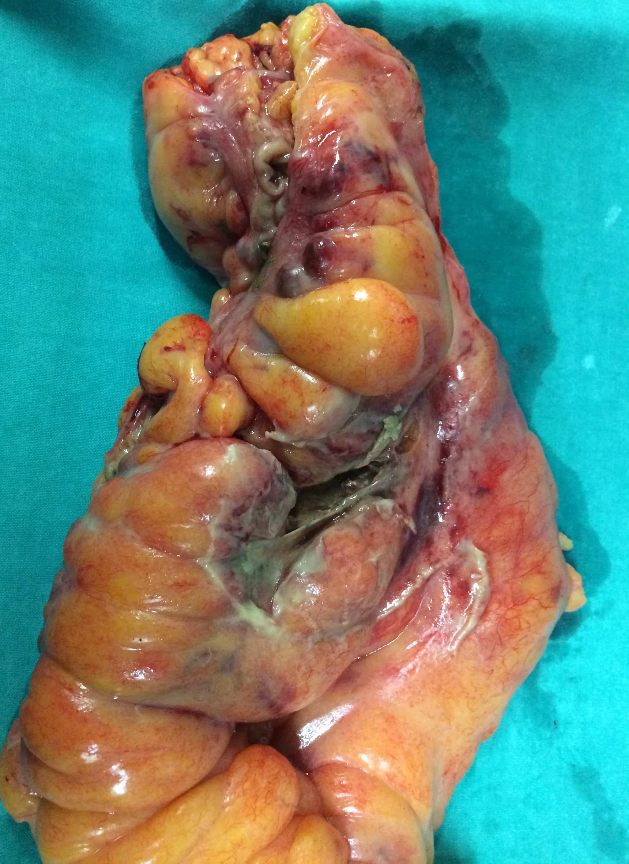 SIGMOID COLON CARCINOMA