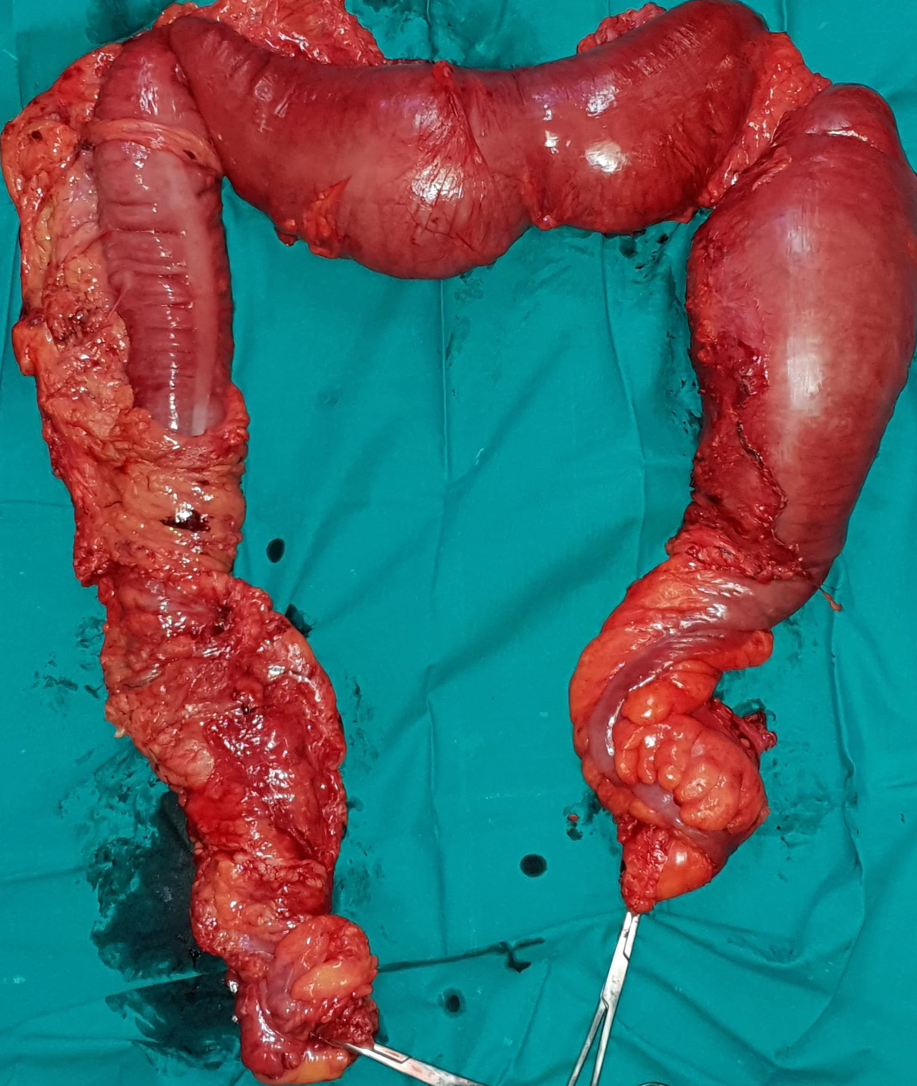 HIRSCHSPRUNG DISEASE 