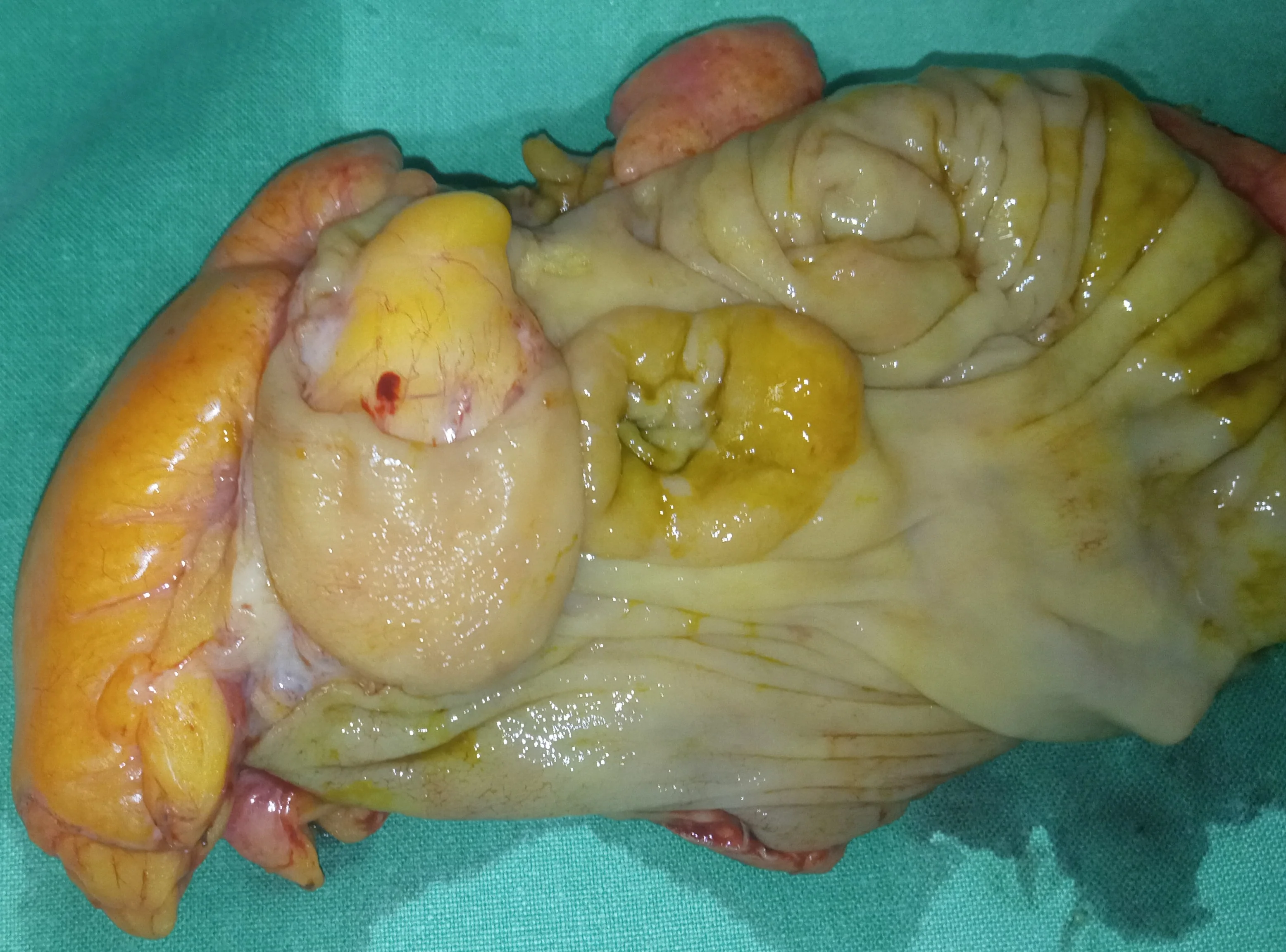 ILEOCECAL LIPOMA