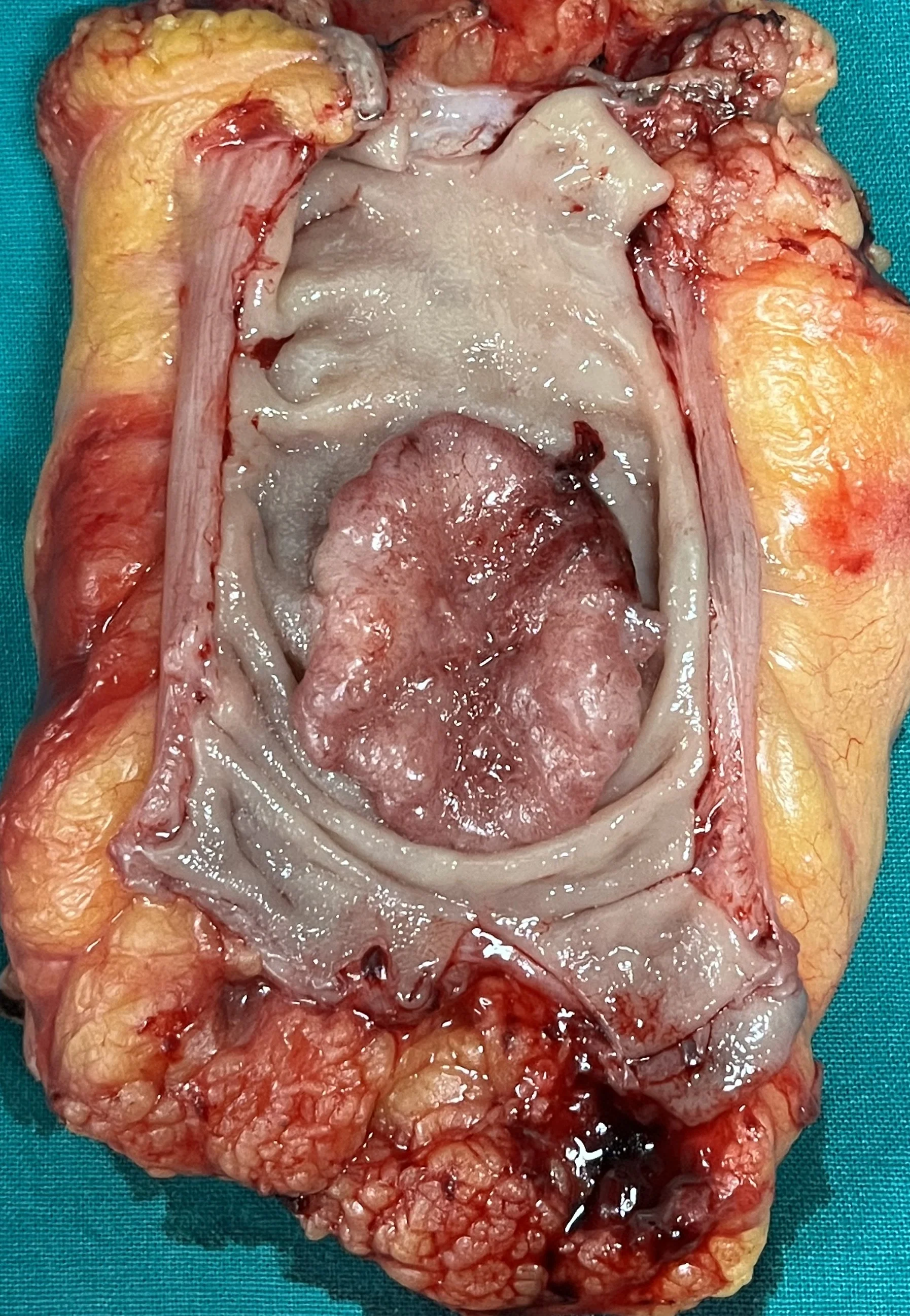 RECTAL CARCINOMA - TOTAL MESORECTAL EXCISION
