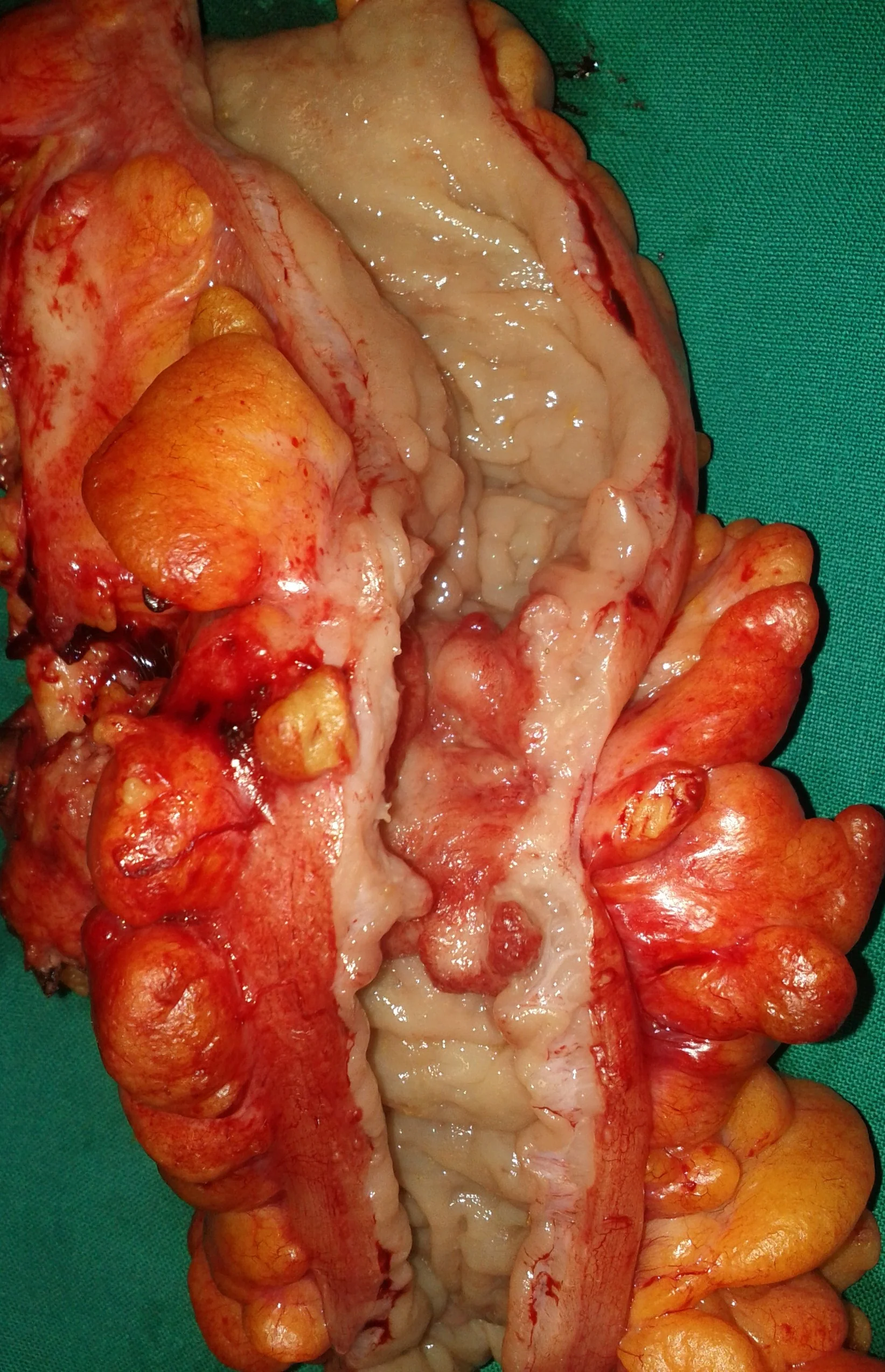 OBSTRUCTING SIGMOID CARCINOMA