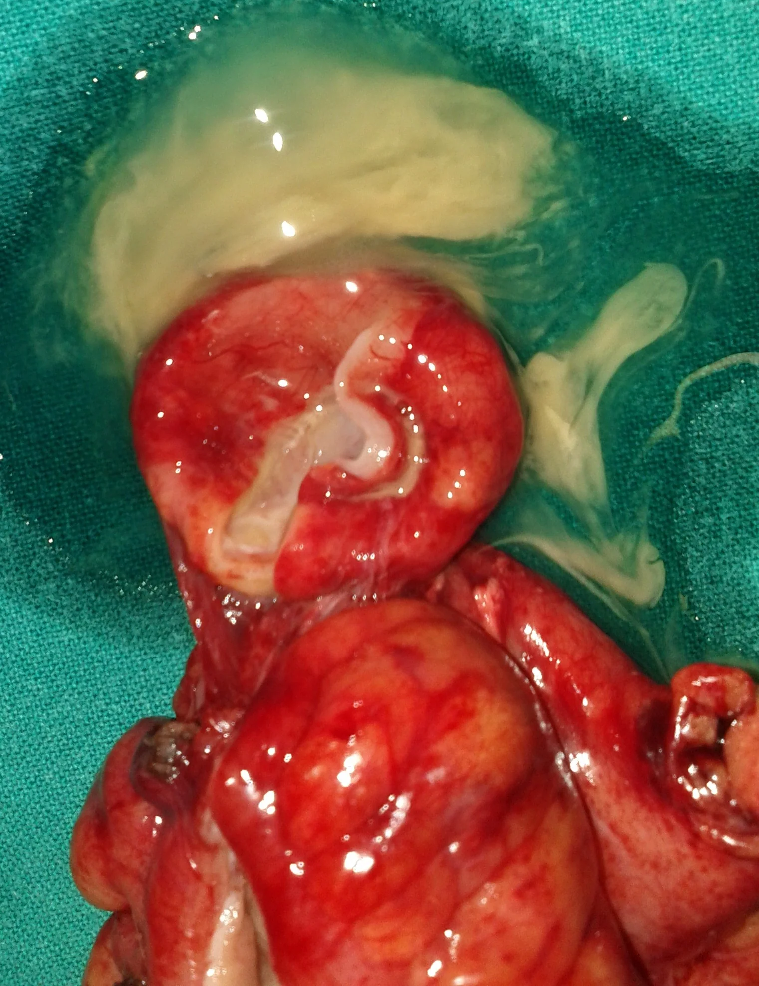 RECURRENCE SIGMOID CARCINOMA