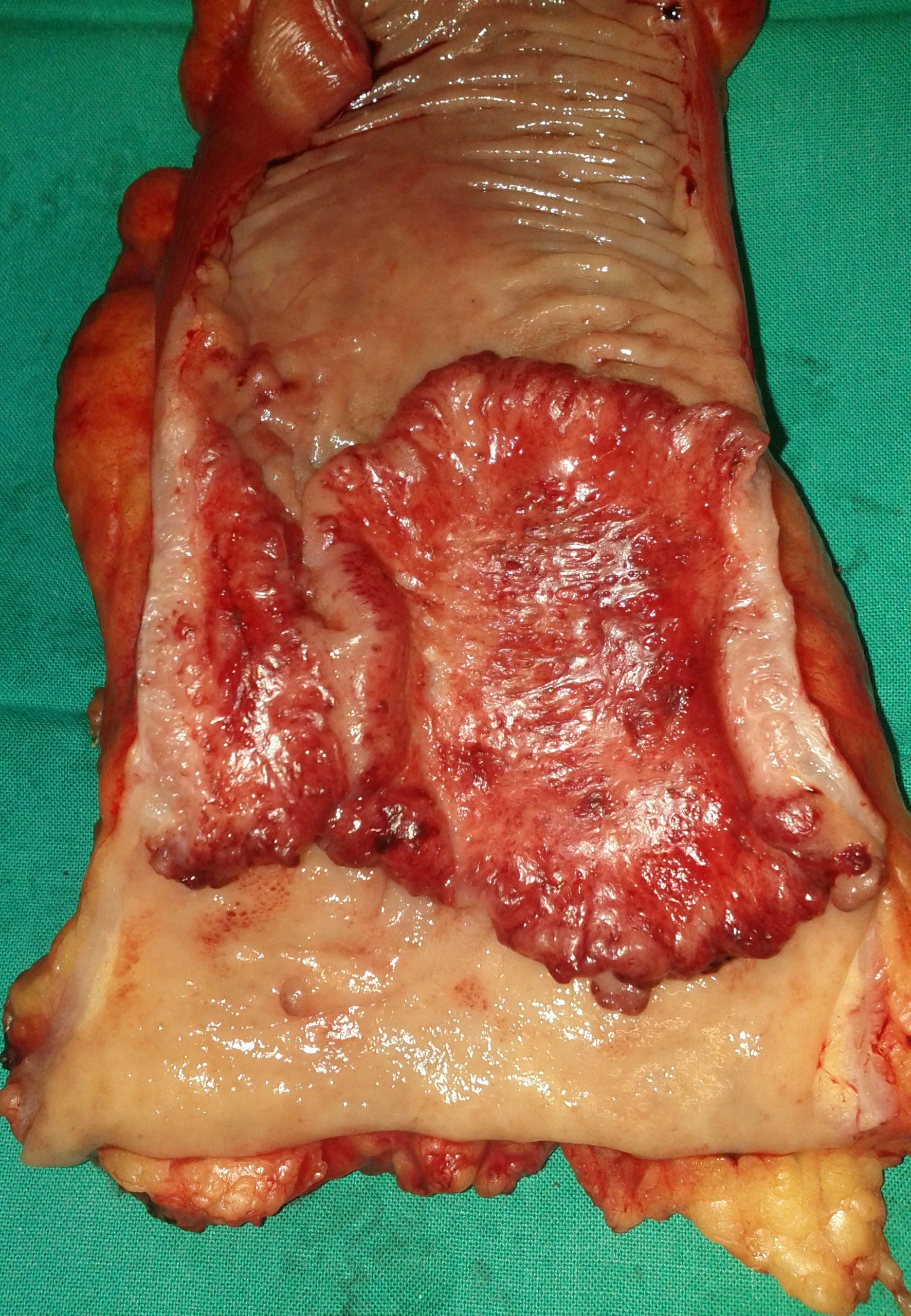RECTAL CARCINOMA