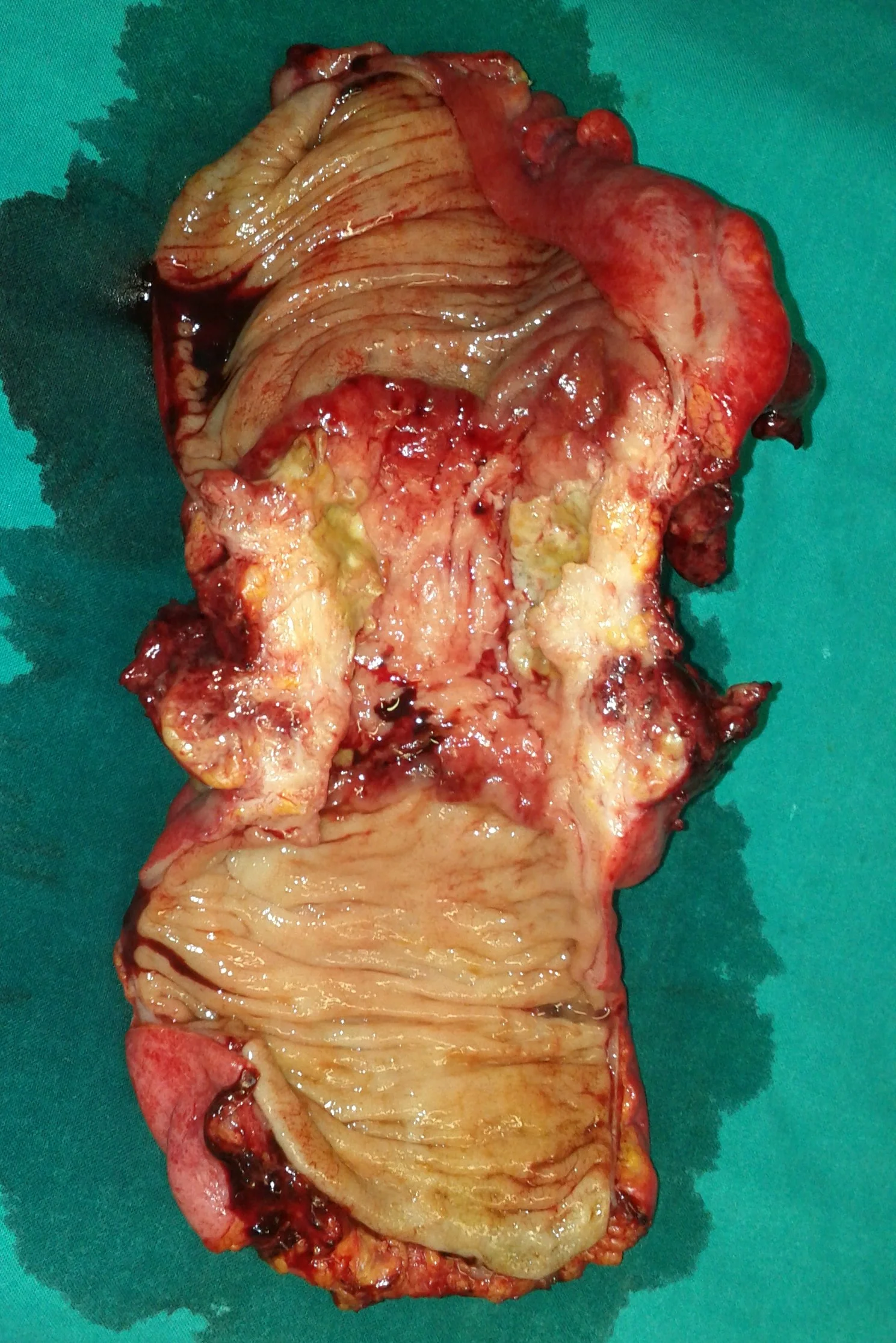 RECTAL CARCINOMA