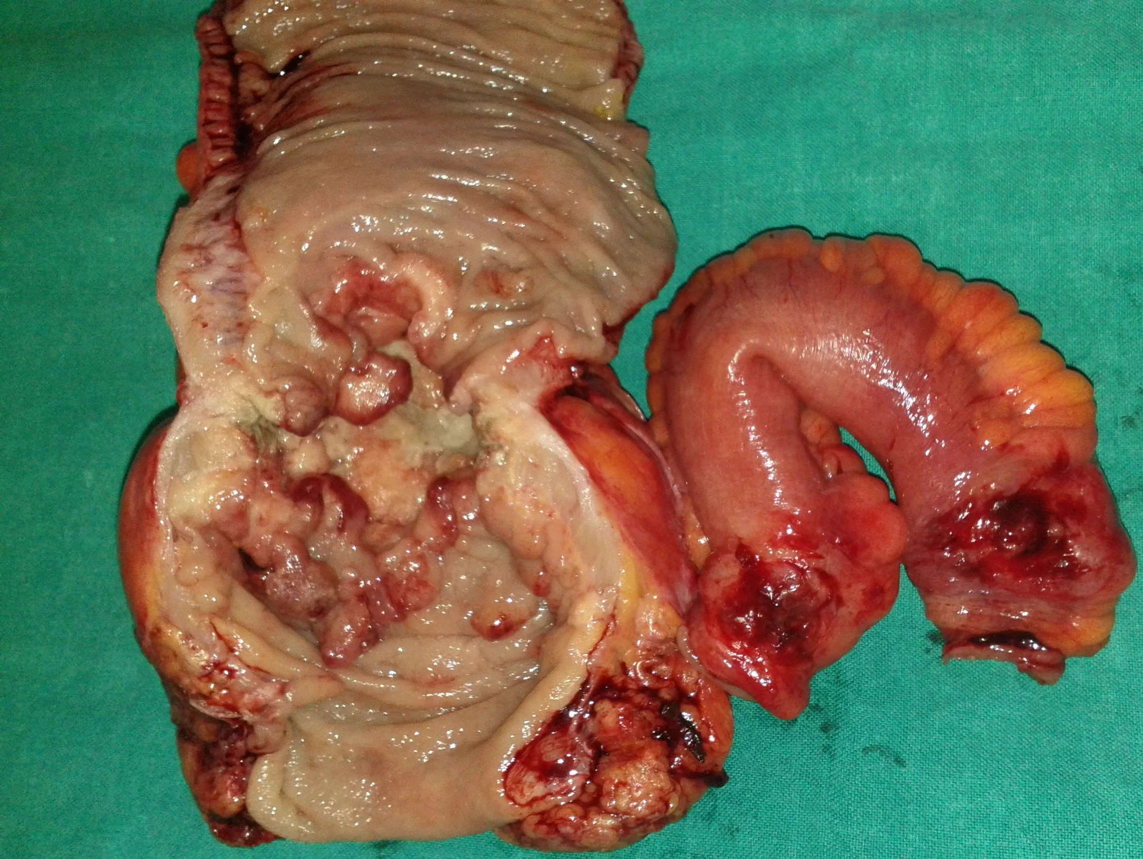 RECTAL CARCINOMA - ADHERENT SMALL BOWEL LOOP
