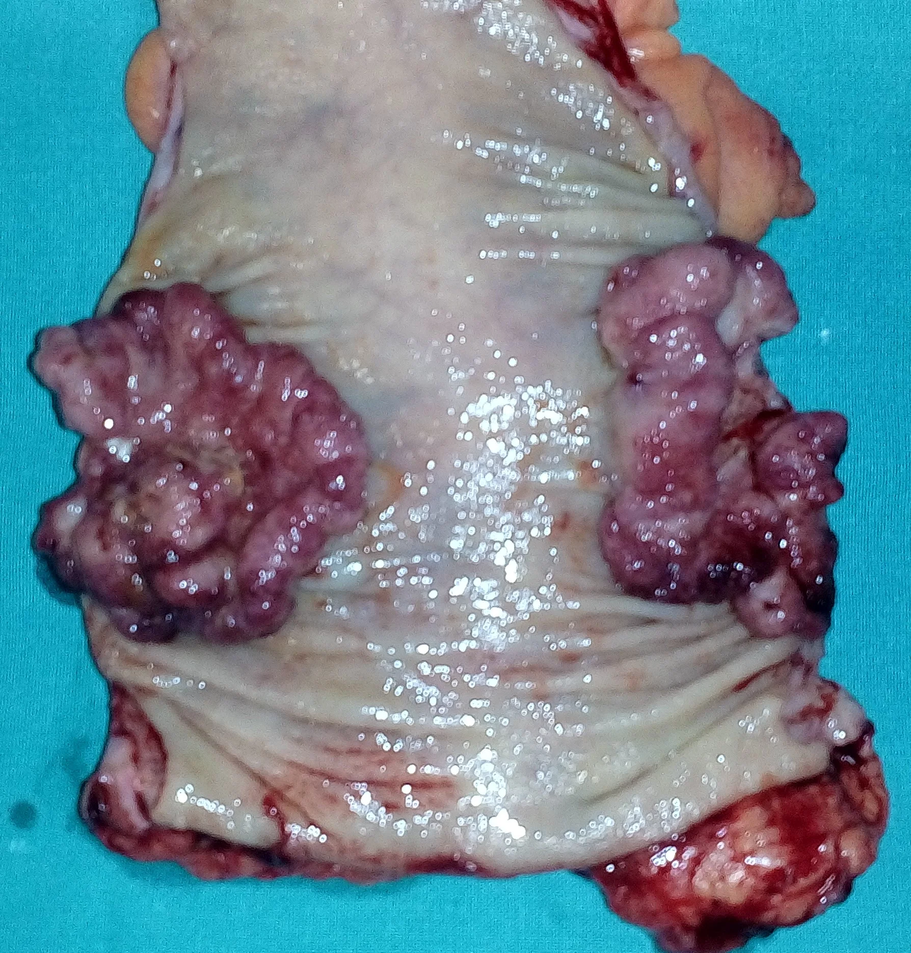 RECTAL CARCINOMA