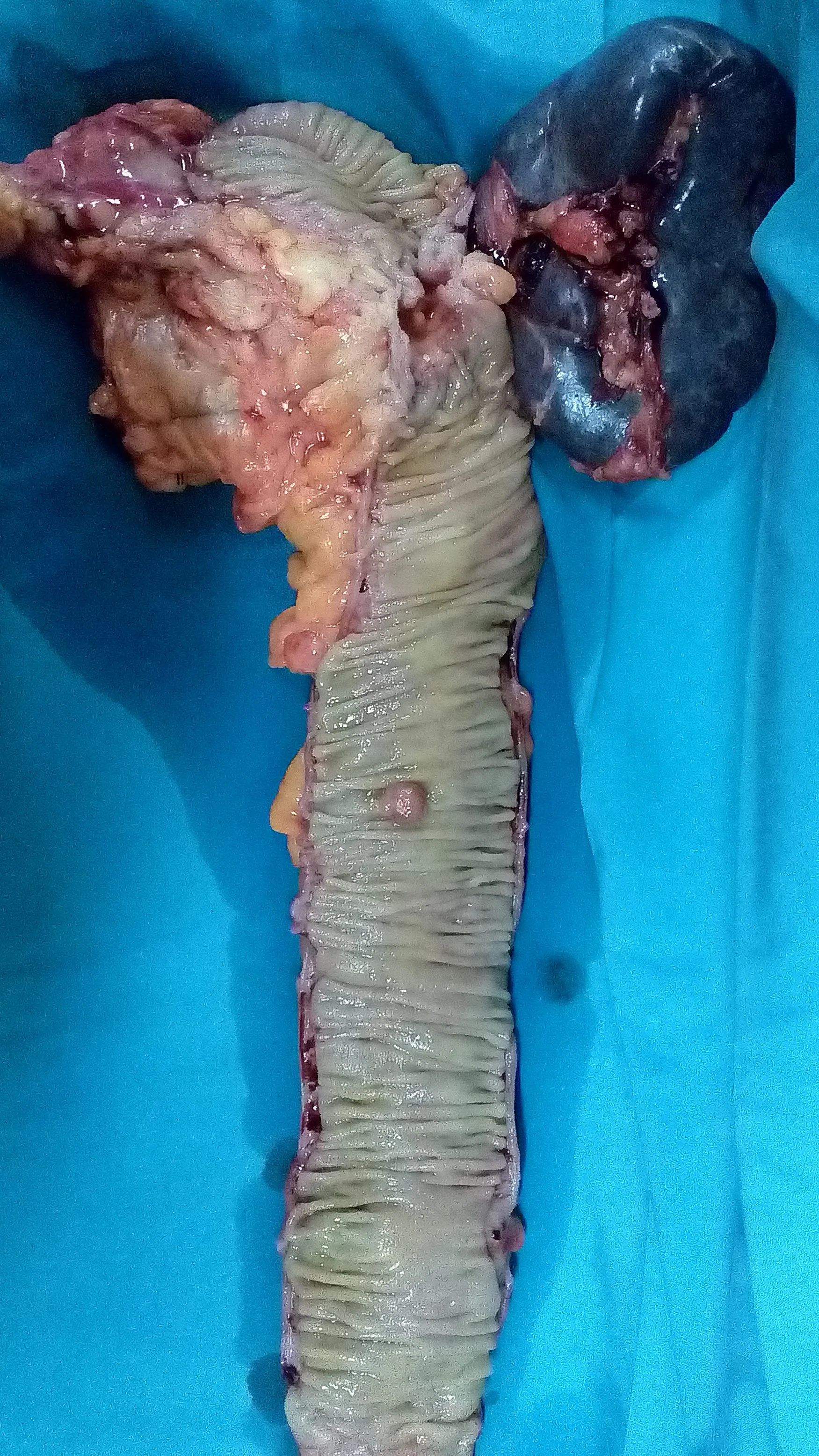 SPLENIC ANGLE COLONIC CARCINOMA