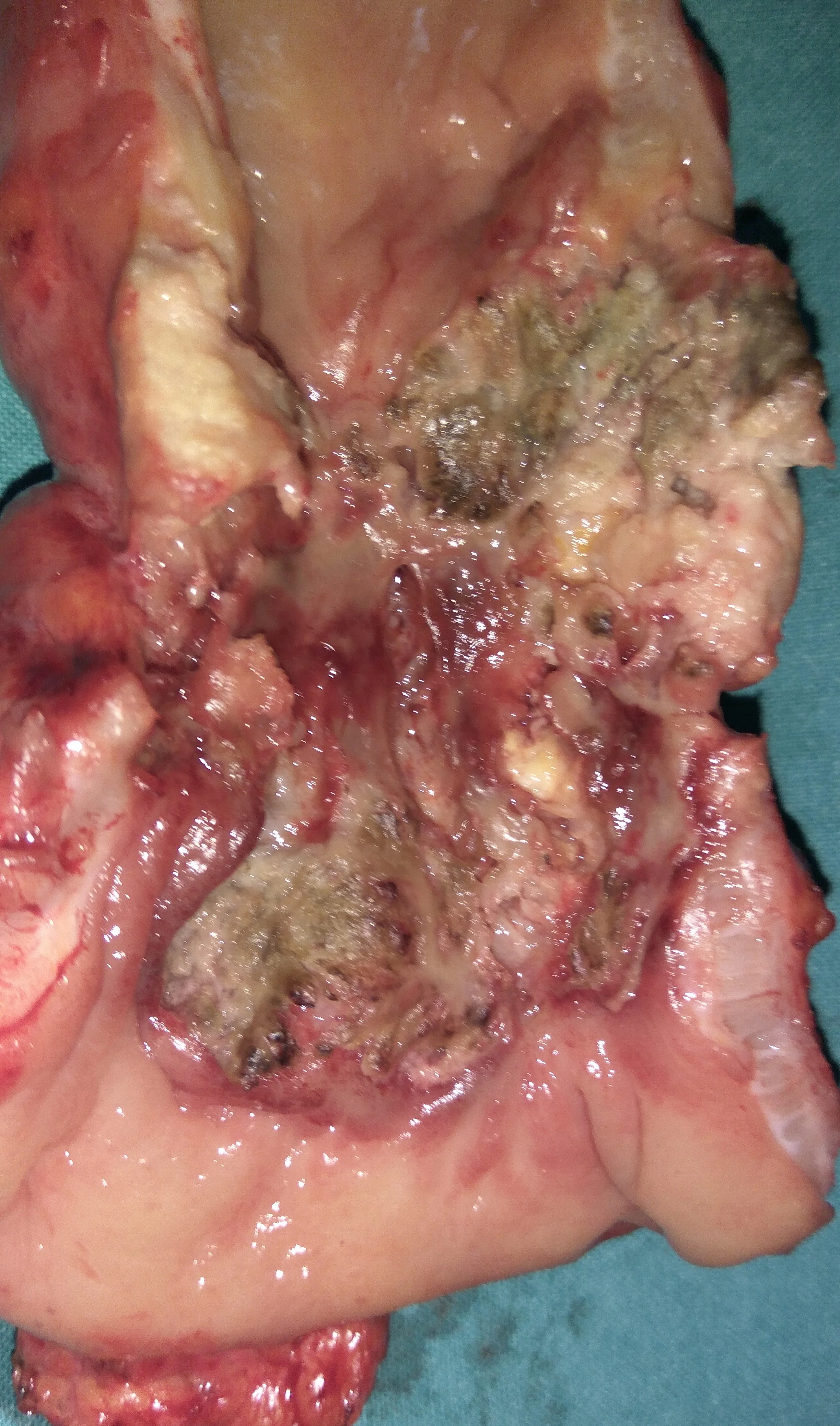 RECTAL CARCINOMA