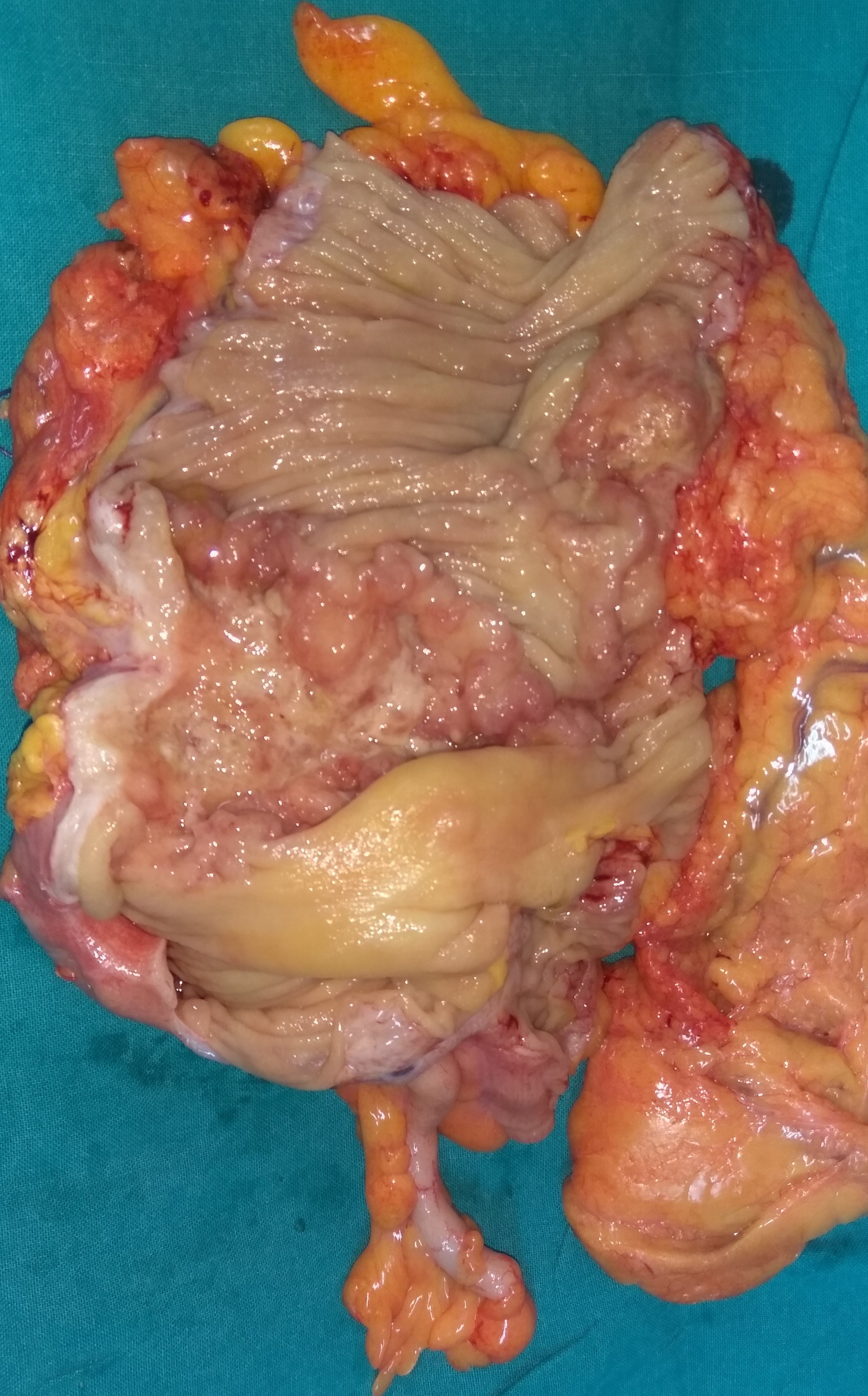 CECAL CARCINOMA