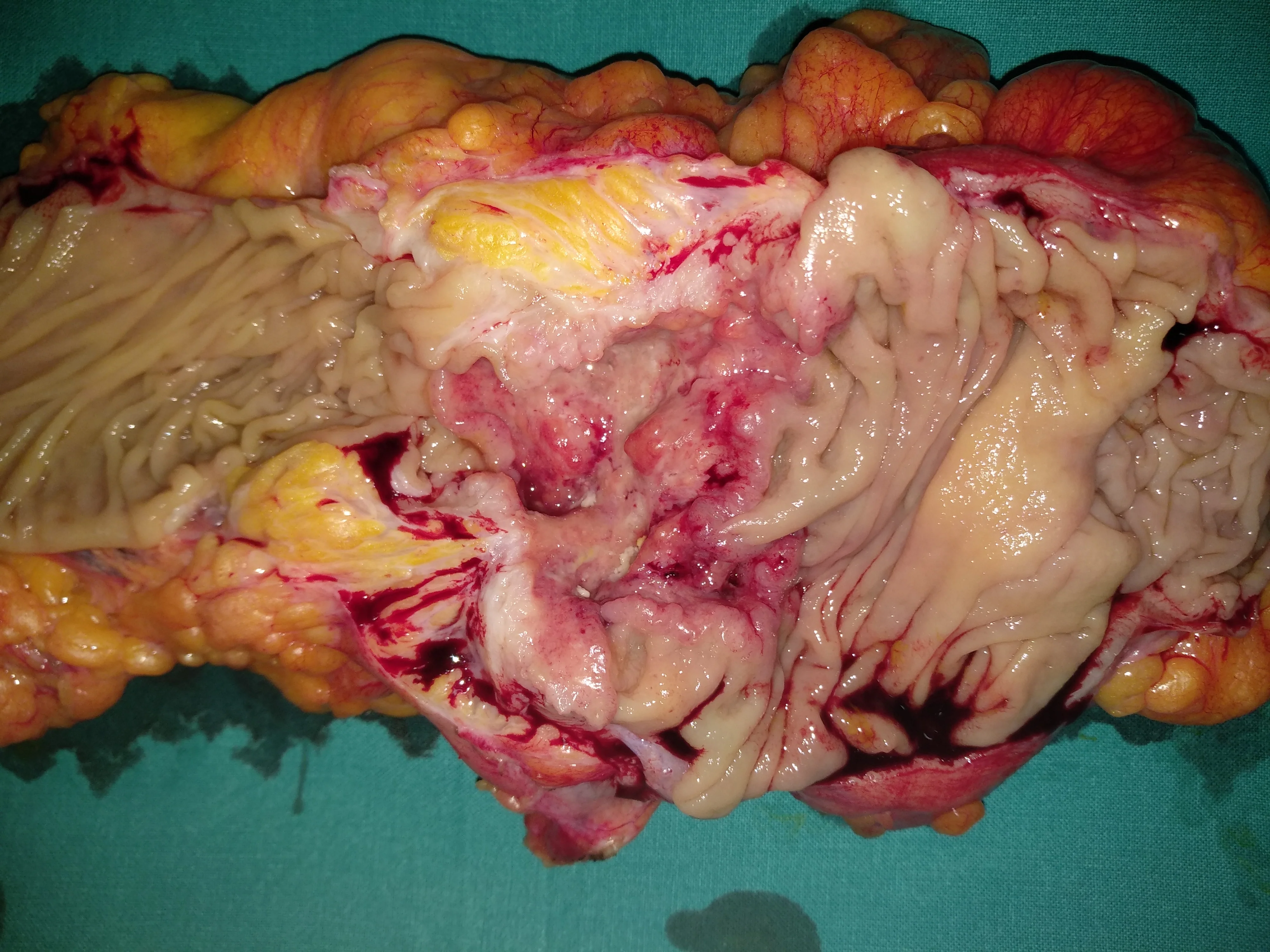 TRANSVERSE COLON CARCINOMA