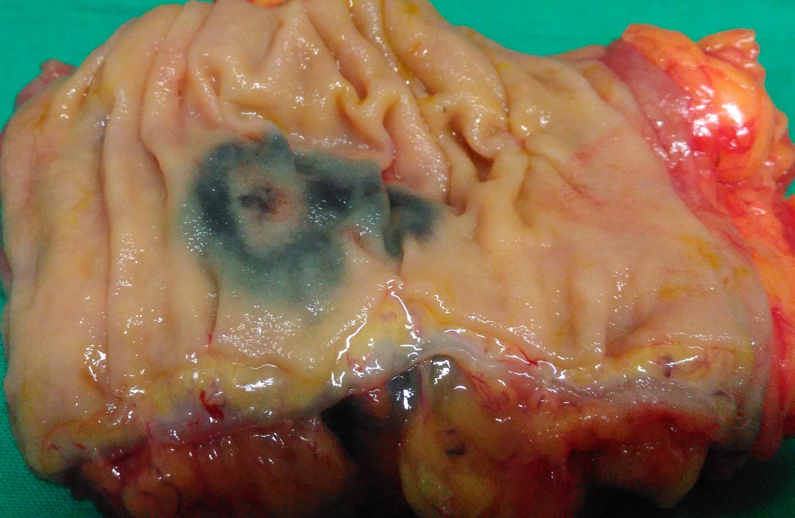 ENDOSCOPIC TATTOOING OF TRANSVERSE COLON CARCINOMA