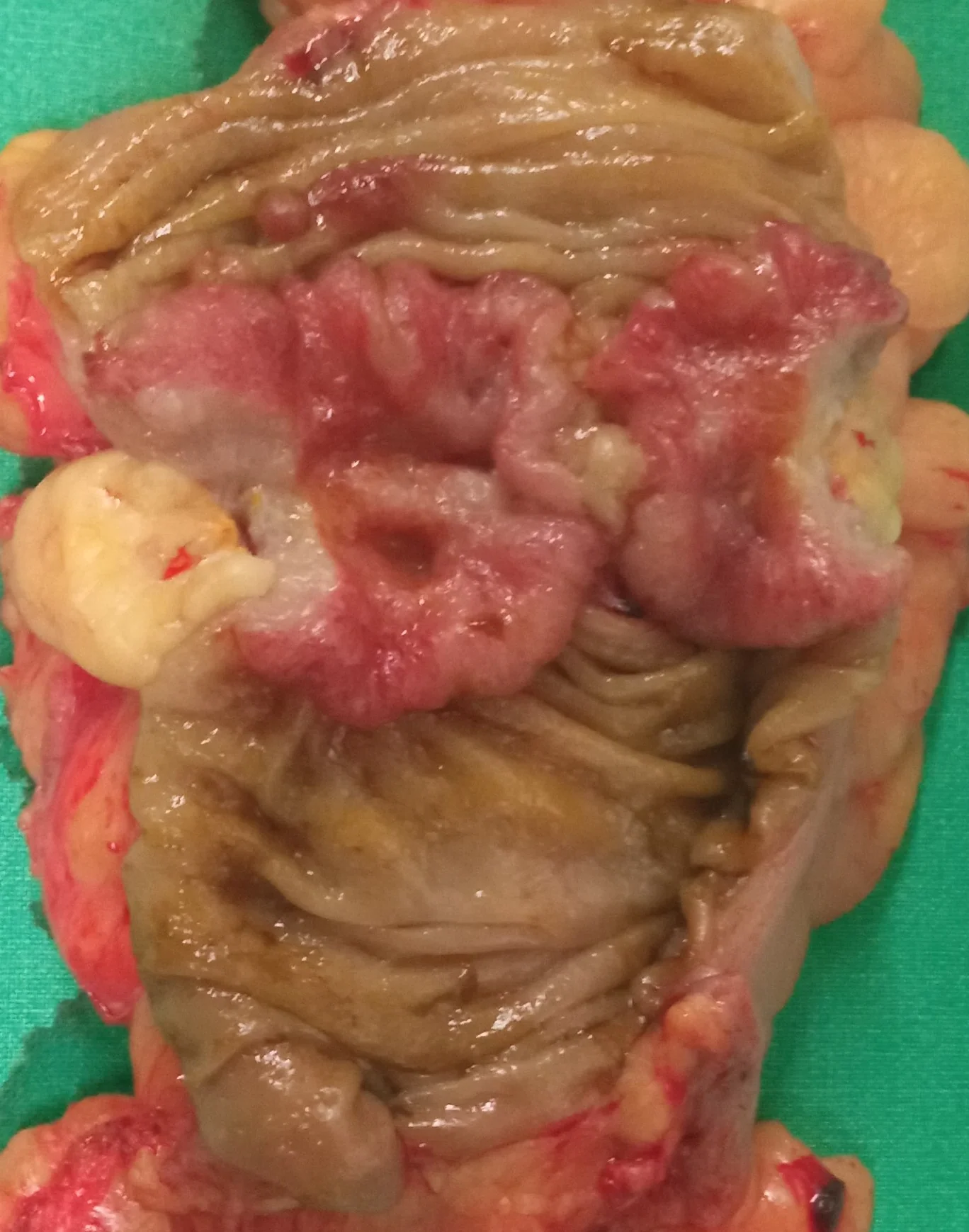 DESCENDING COLON CARCINOMA