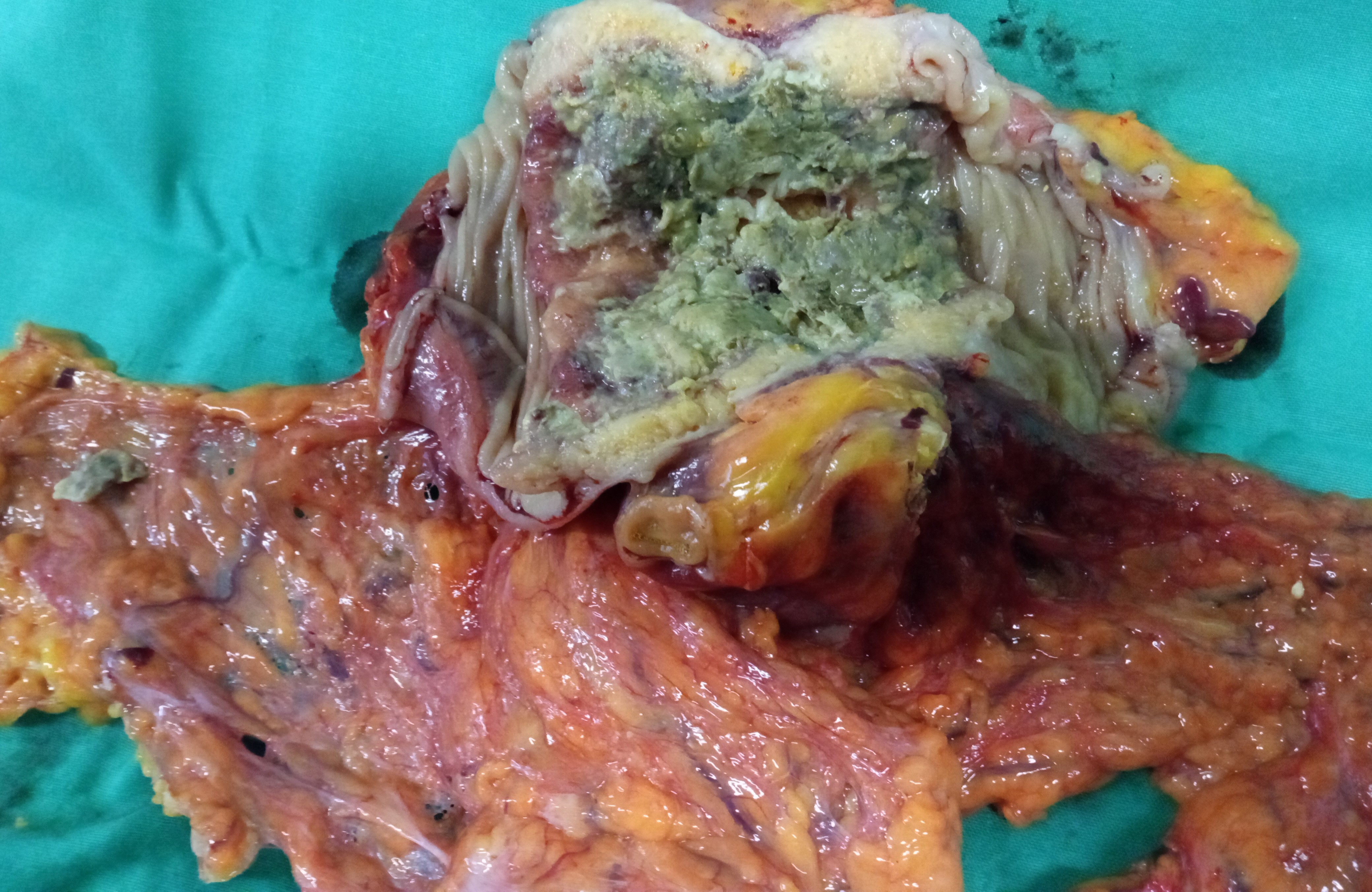 TRANSVERSE COLON CARCINOMA