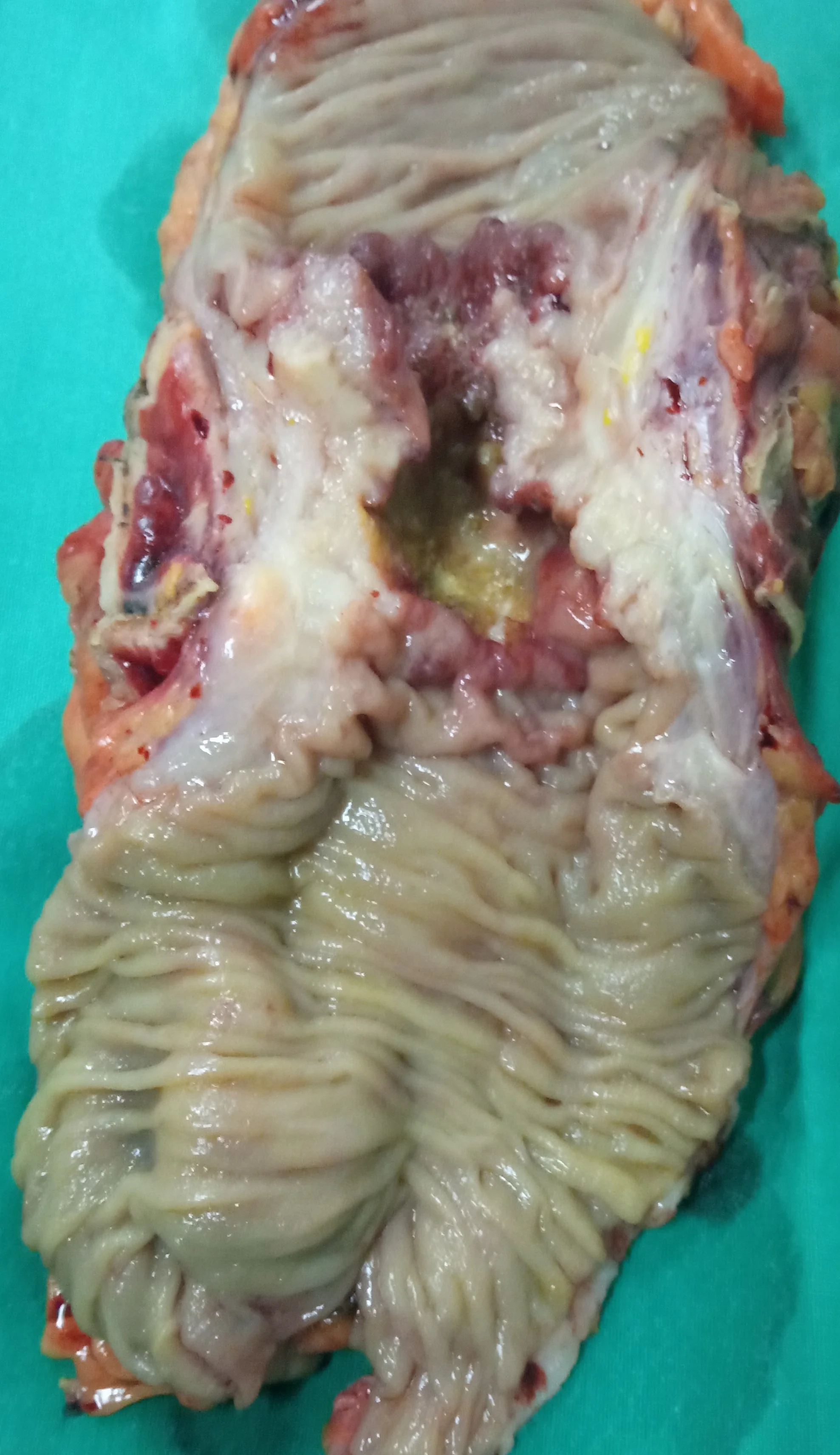 PERFORATING SIGMOID CARCINOMA