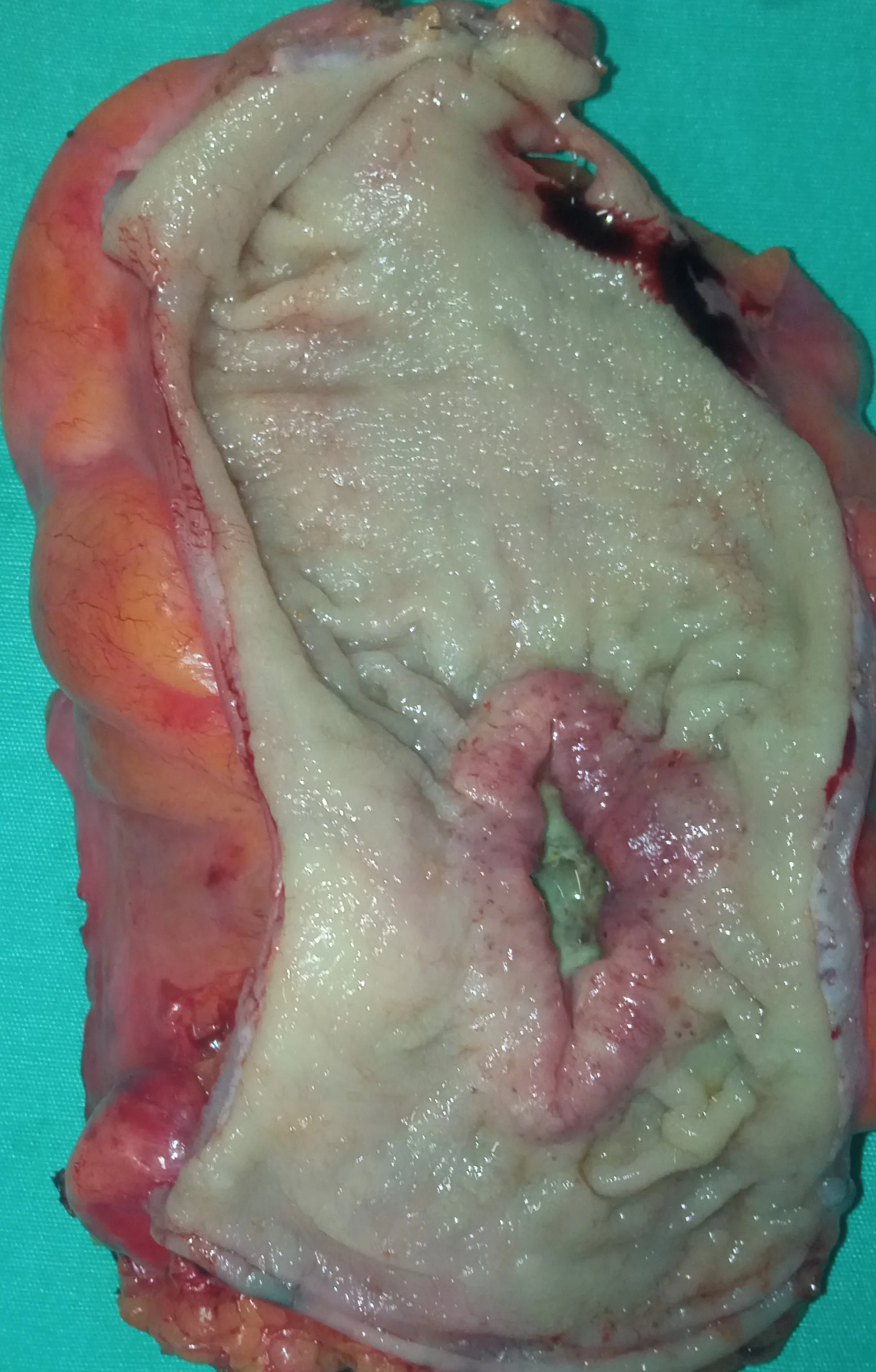 RECTAL CARCINOMA