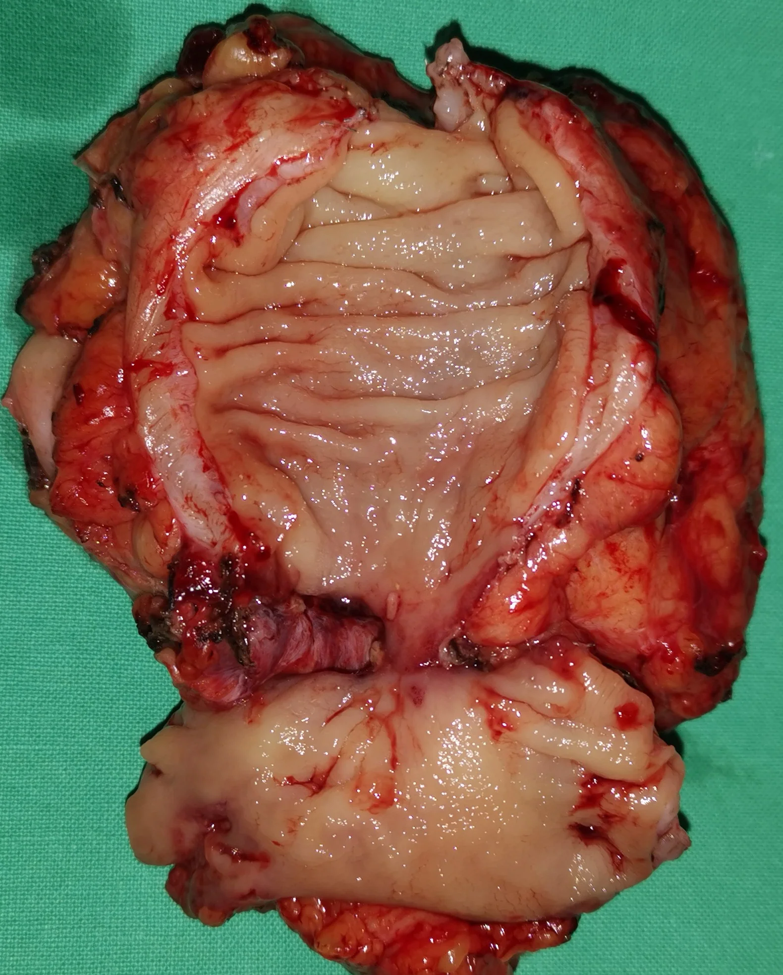 RECTAL CARCINOMA