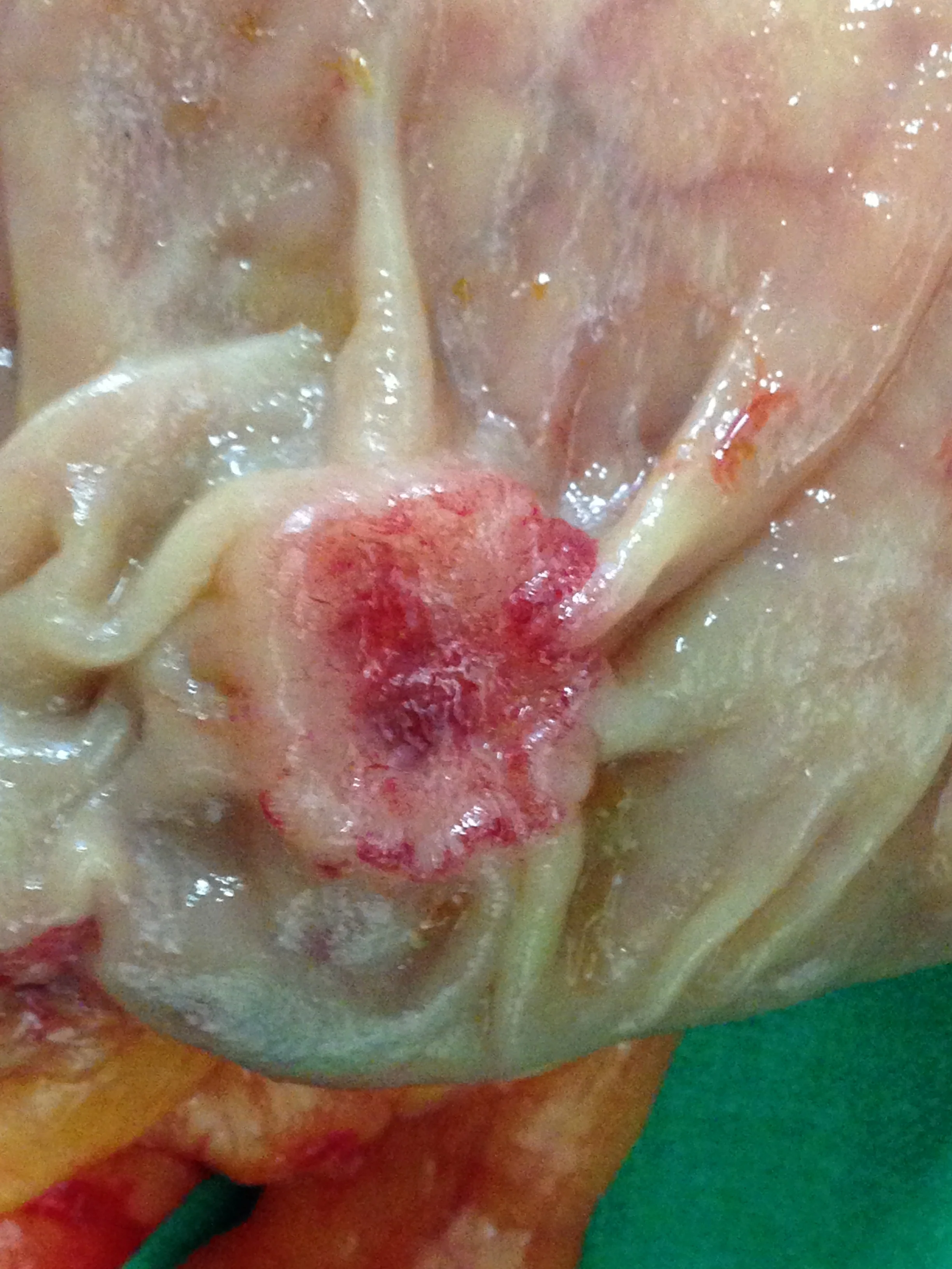 DESCENDING COLON CARCINOMA