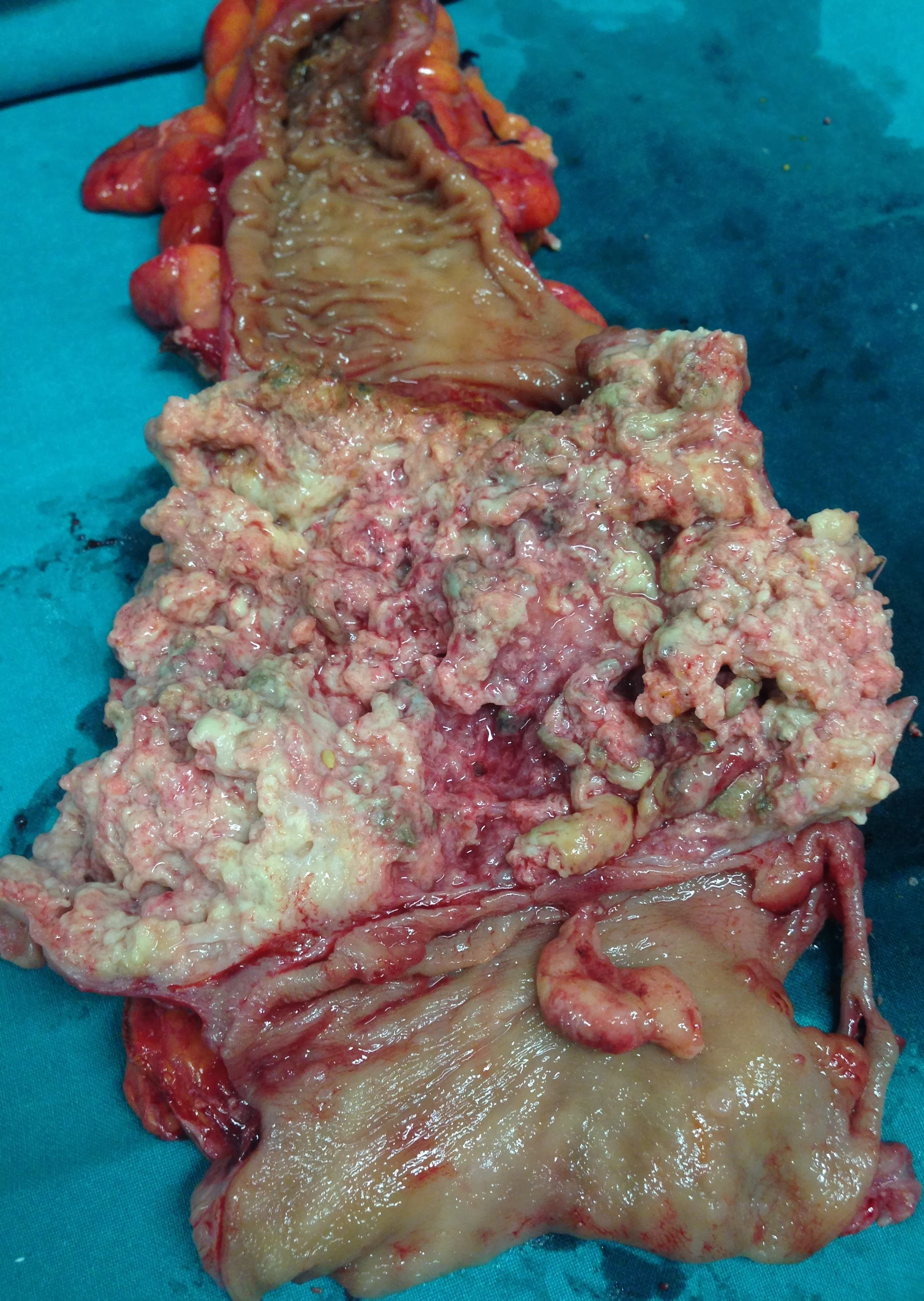 NECROTIZING RECTAL CARCINOMA 