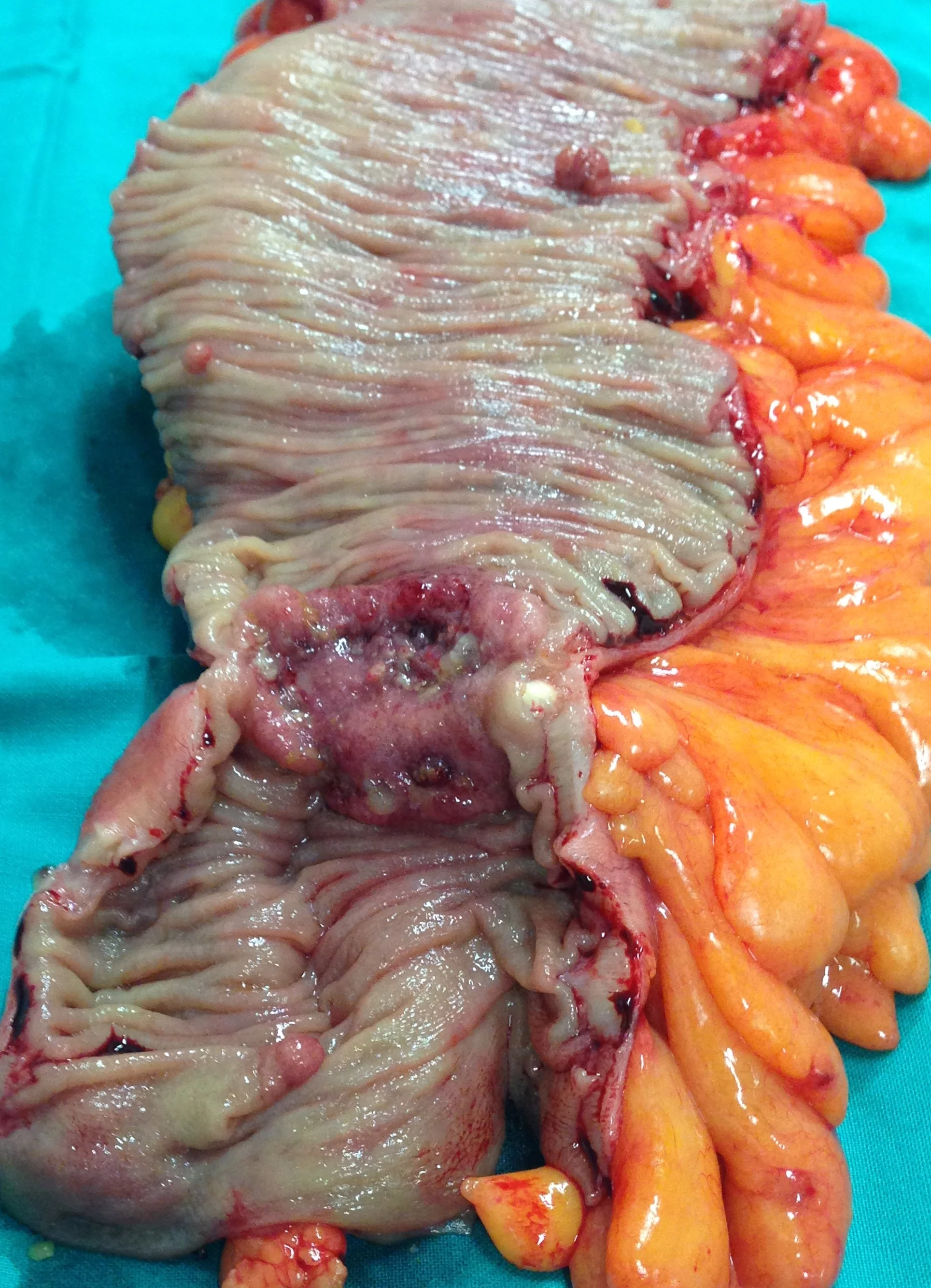 DESCENDING COLON CARCINOMA