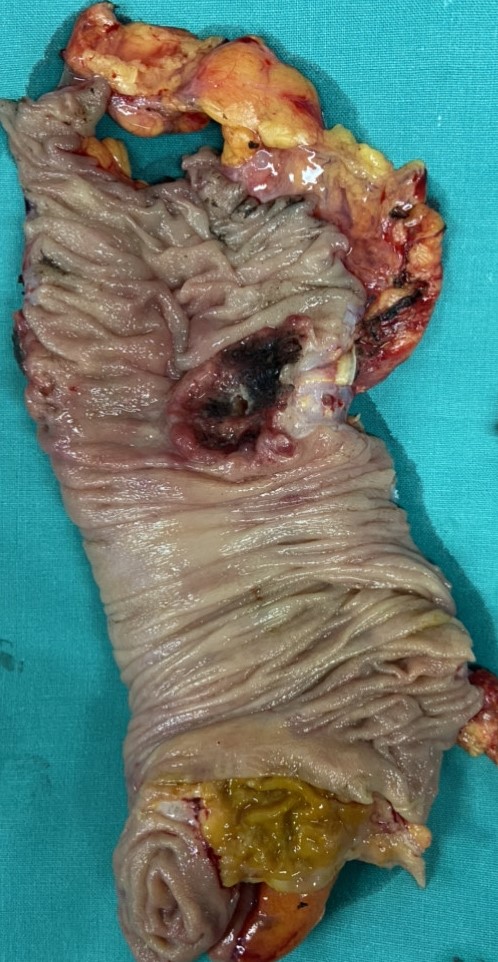 ASCENDING COLON CARCINOMA