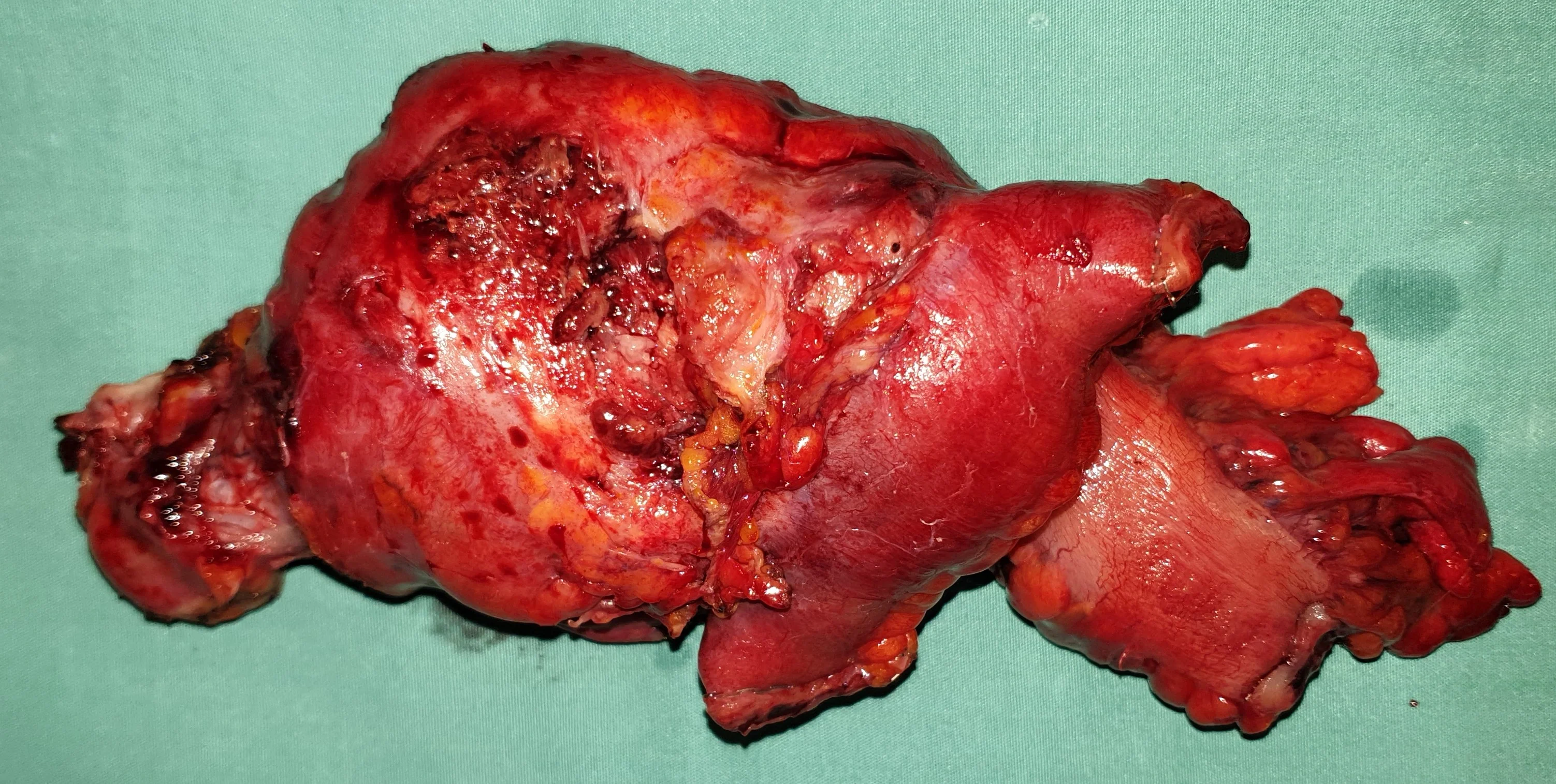 INFLAMMATORY CECAL PSEUDOTUMOR