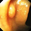 INVERTED DIVERTICULUM