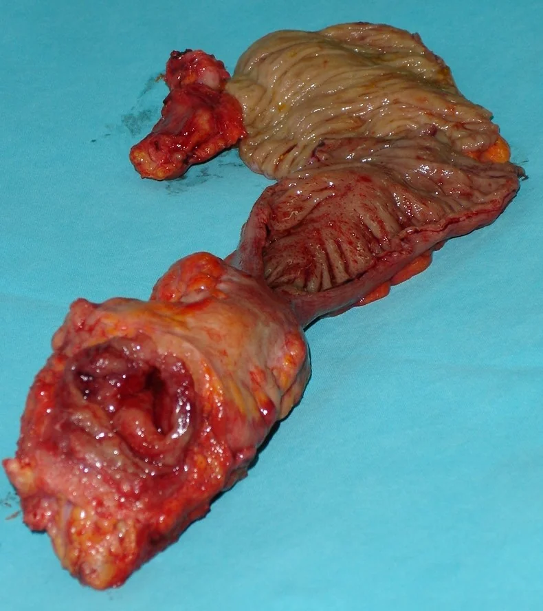 RECTAL MiNEN