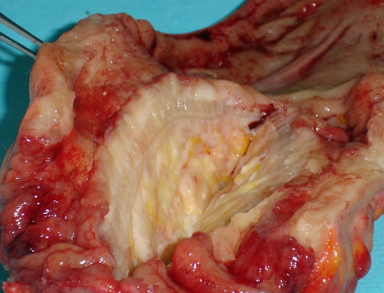 CROSS SECTION RECTAL MiNEN