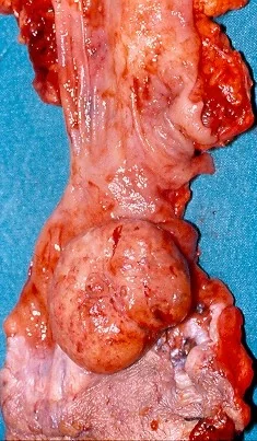 SYNCHRONOUS RECTAL CARCINOMA AND MELANOMA
