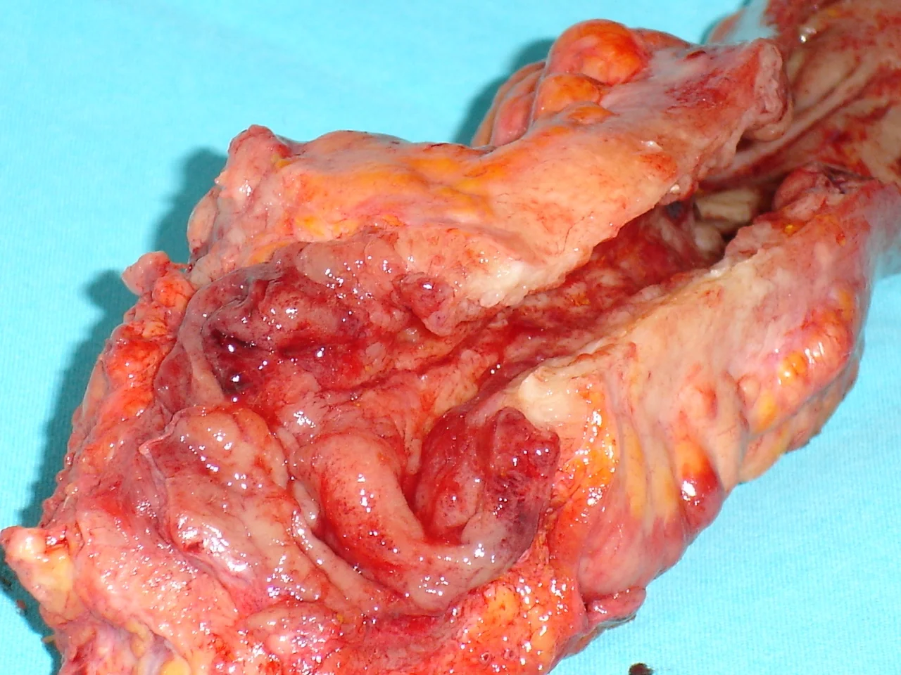 RECTAL MANEC