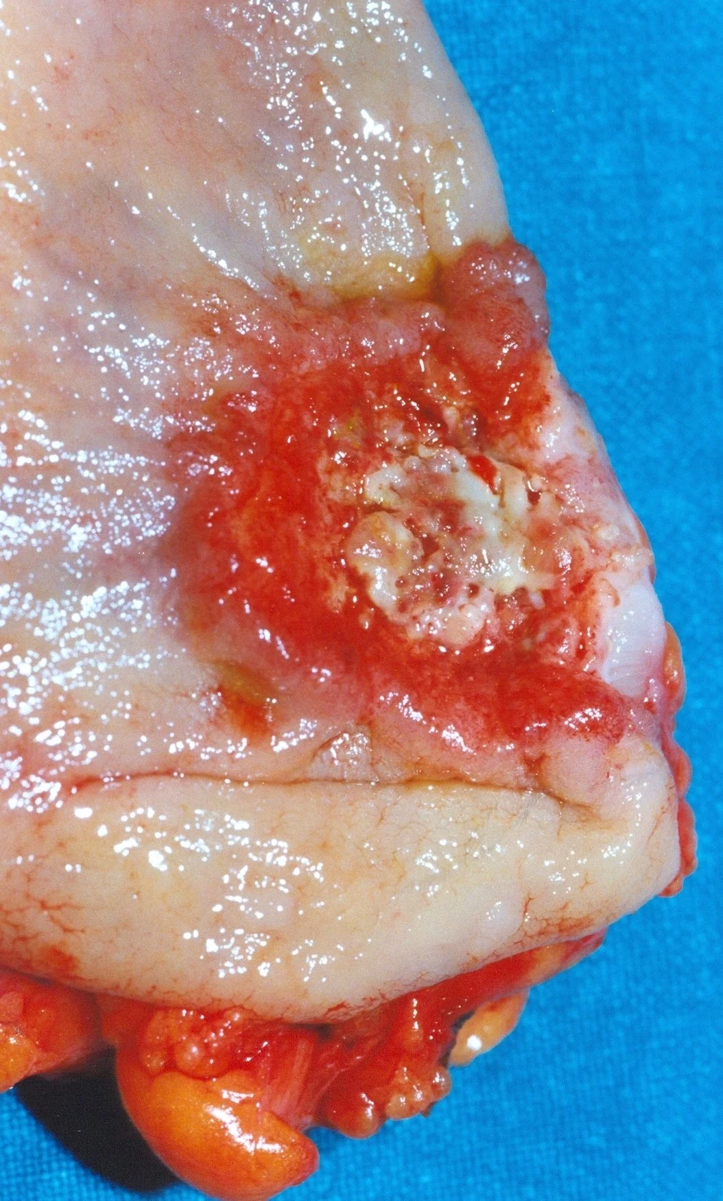 RECTAL CARCINOMA