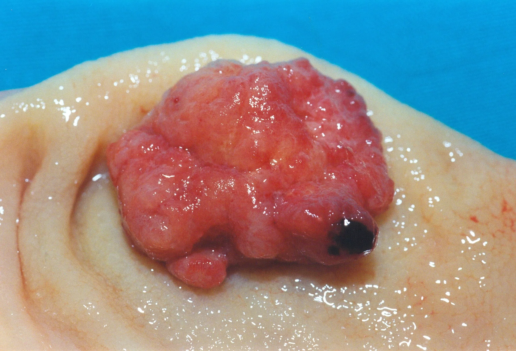 RECTAL CARCINOMA - PRE-OP R/T