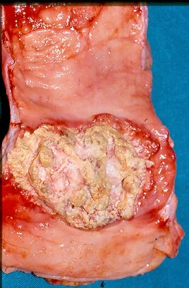 FULL COURSE R/T - TUMOR NECROSIS