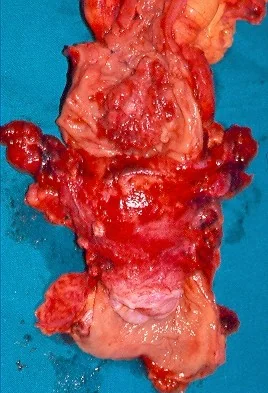 EN BLOC LOW ANTERIOR RESECTION AND TOTAL HYSTERECTOMY 
