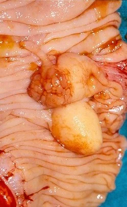 SIGMOID COLON CARCINOMA + LIPOMA