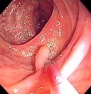 LONG INVERTED DIVERTICULUM