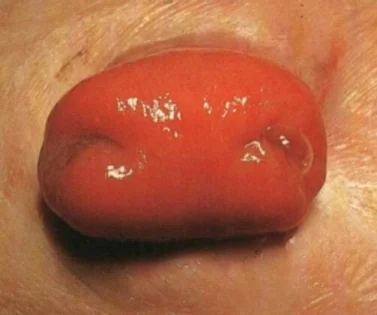 LOOP COLOSTOMY