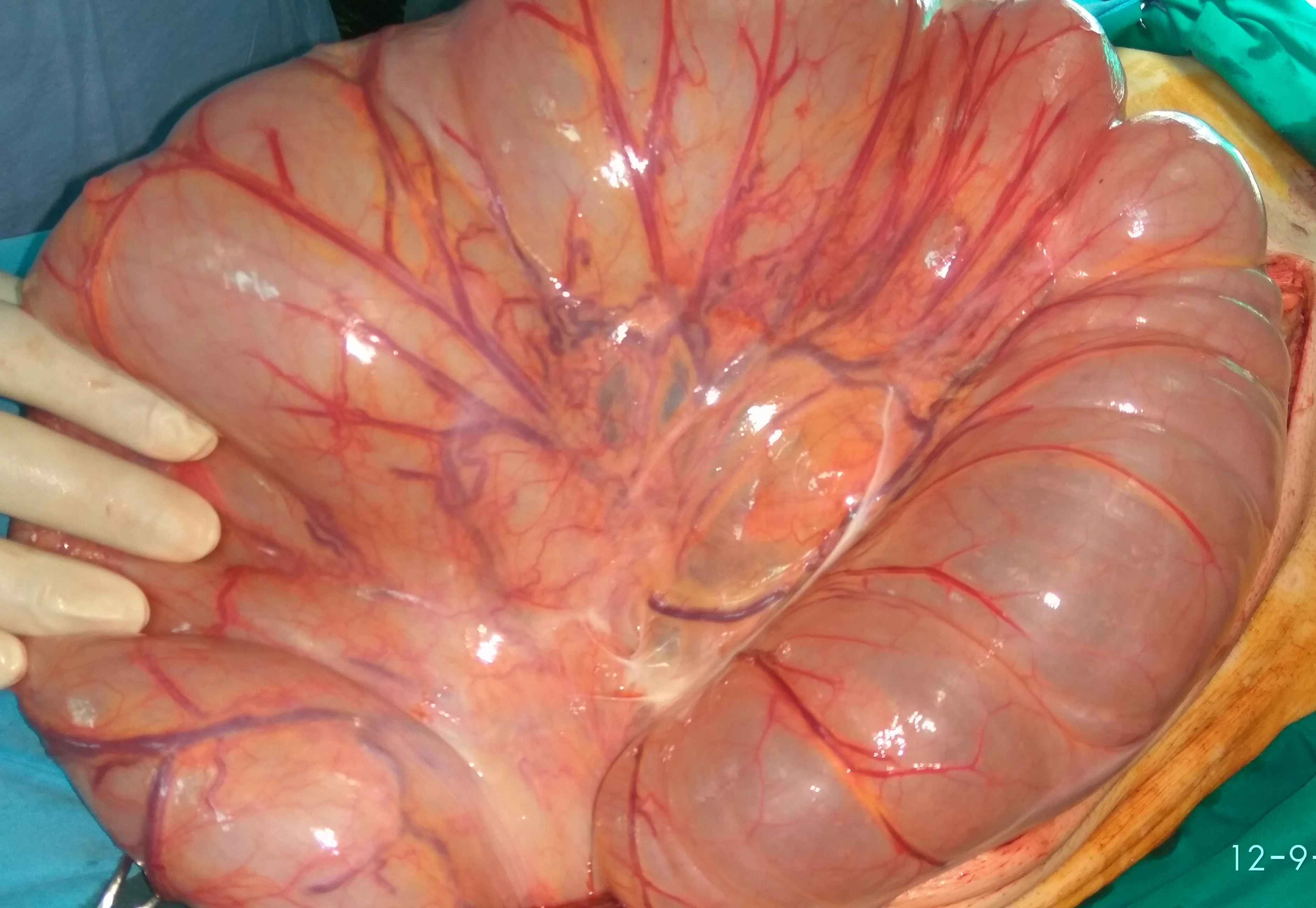MEGACOLON