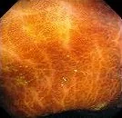 MELANOSIS COLI