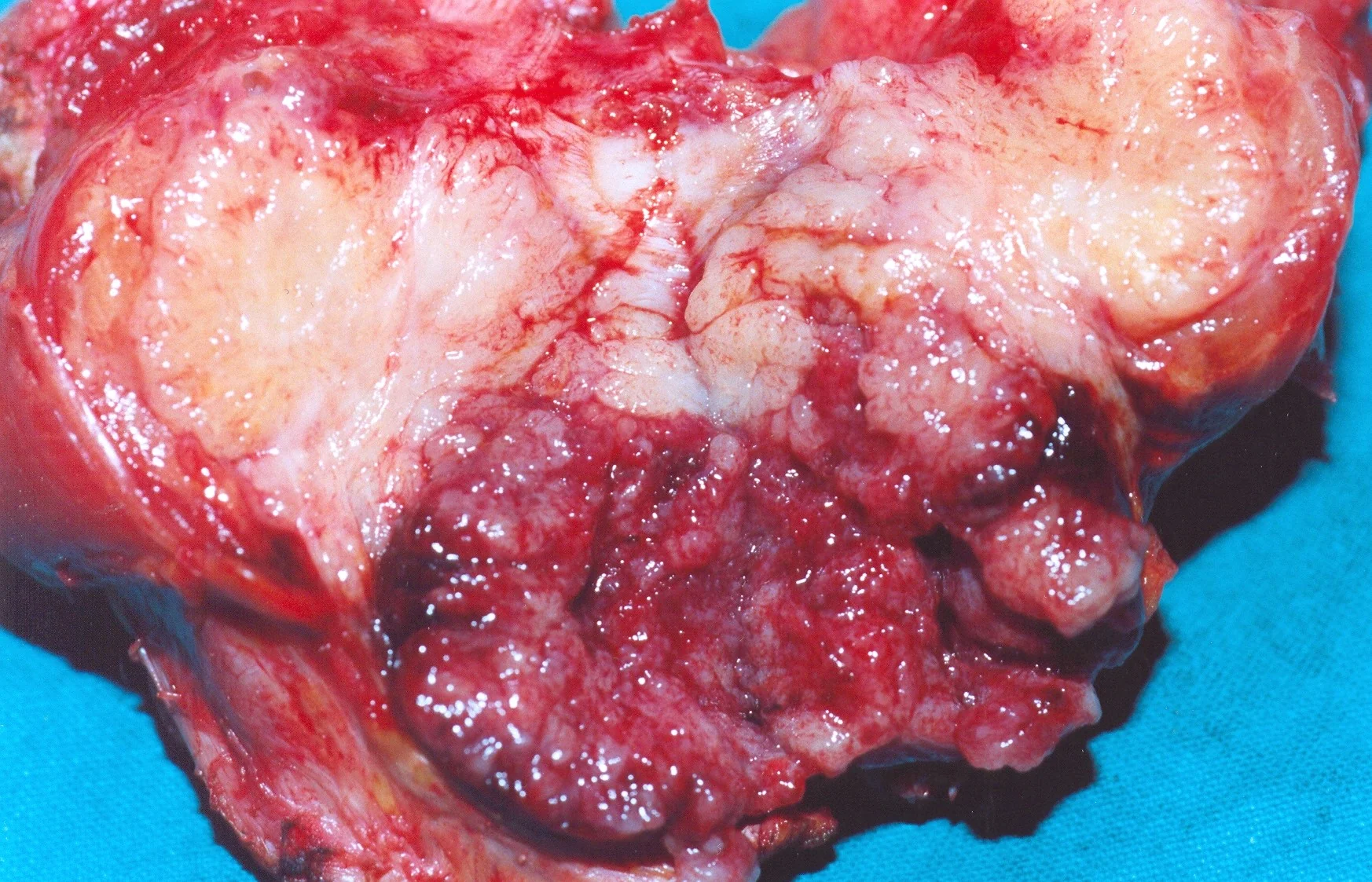 METASTATIC RECTAL CARCINOMA