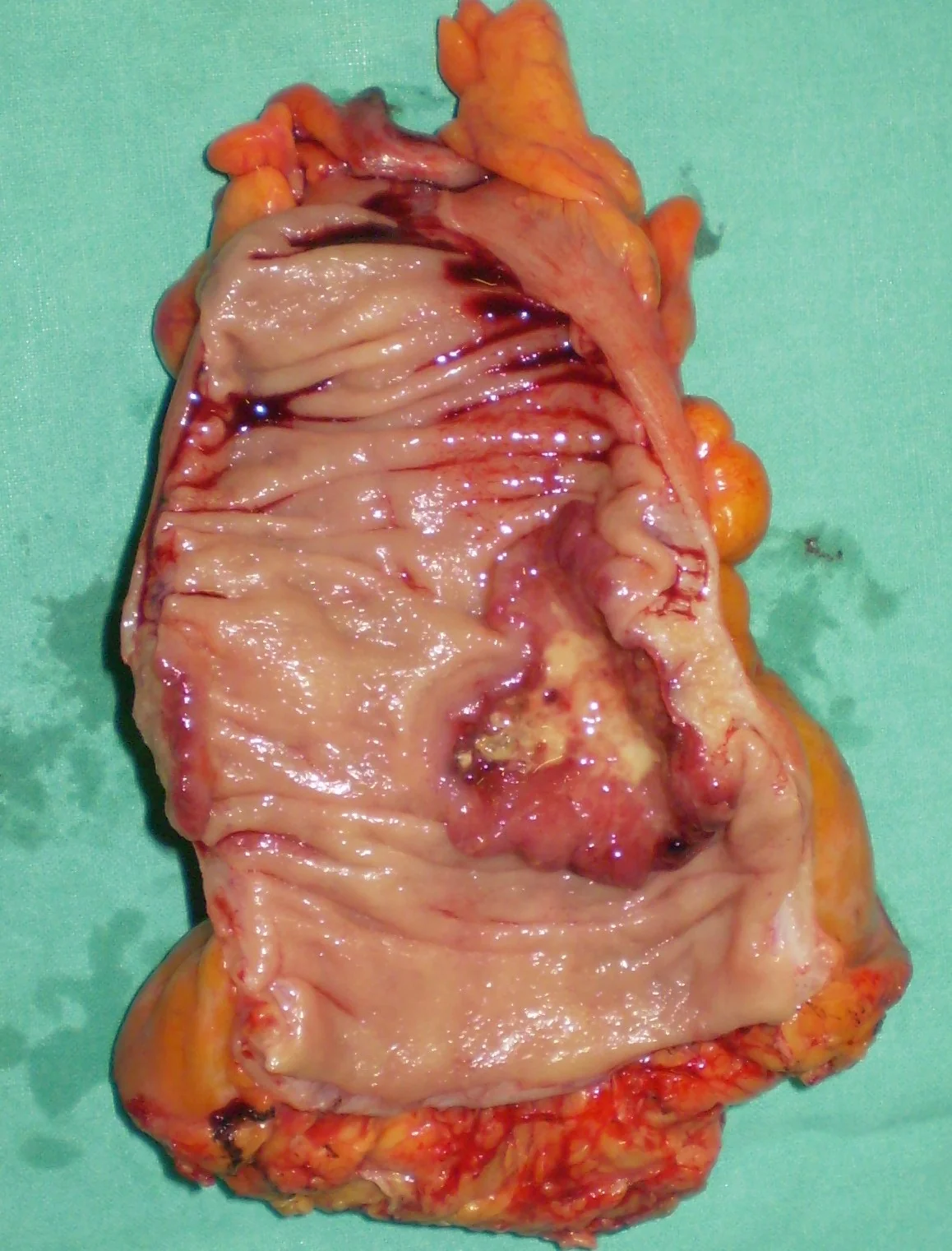 RECTAL CARCINOMA 