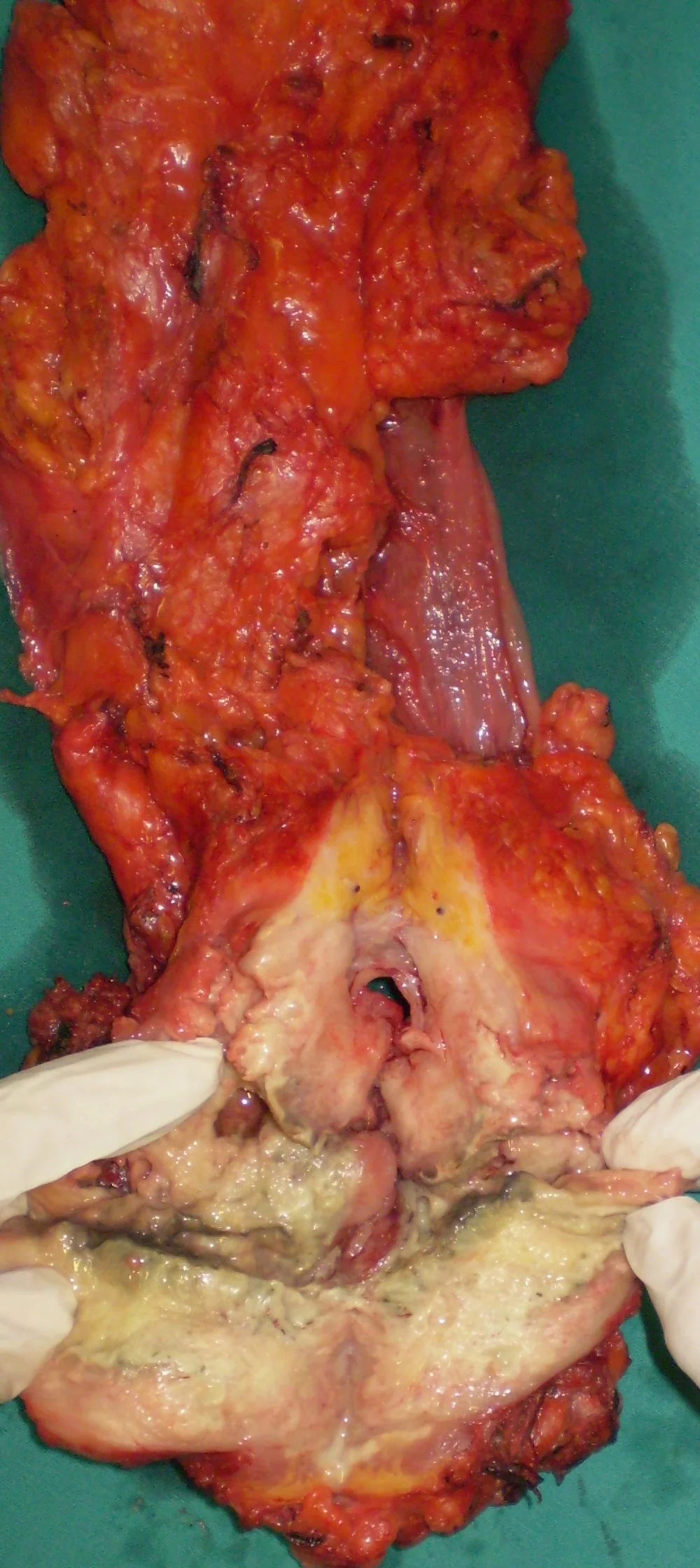MESORECTUM INFILTRATION
