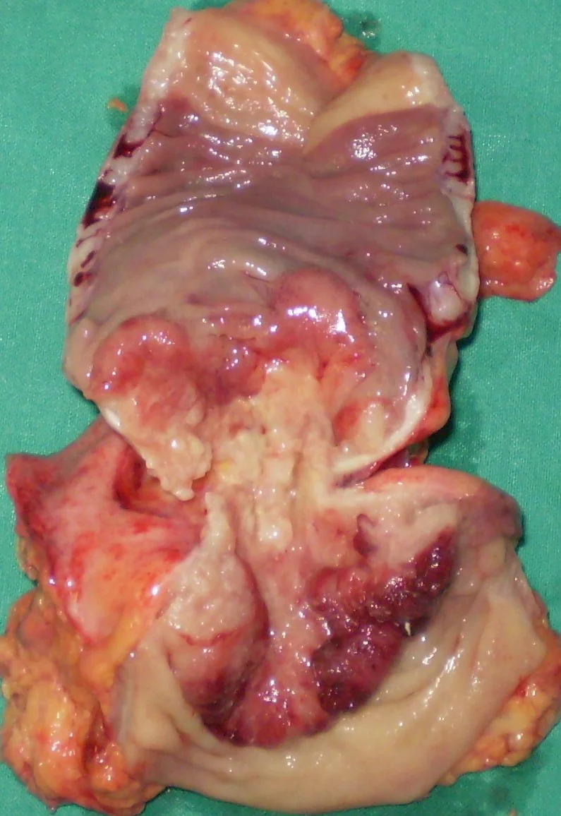 RECTAL CARCINOMA