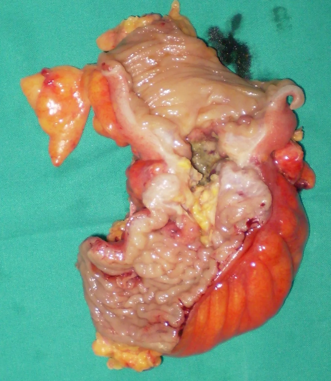 DESCENDING COLON CARCINOMA