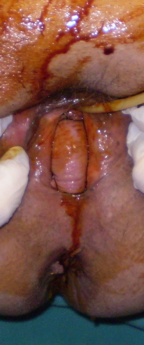 ANTERIOR RECTOCELE