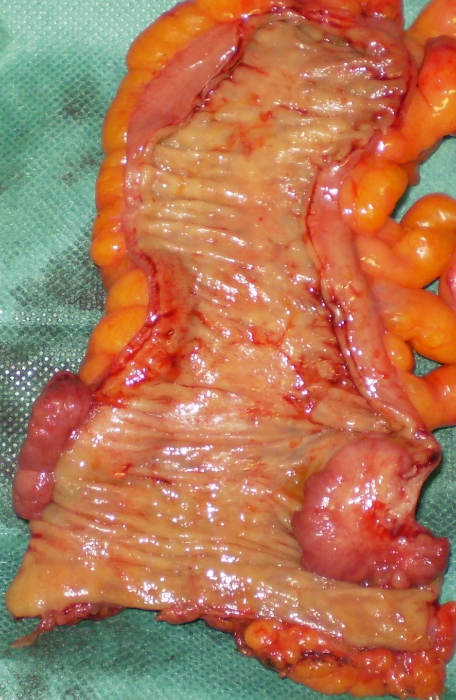 RECTAL CARCINOMA