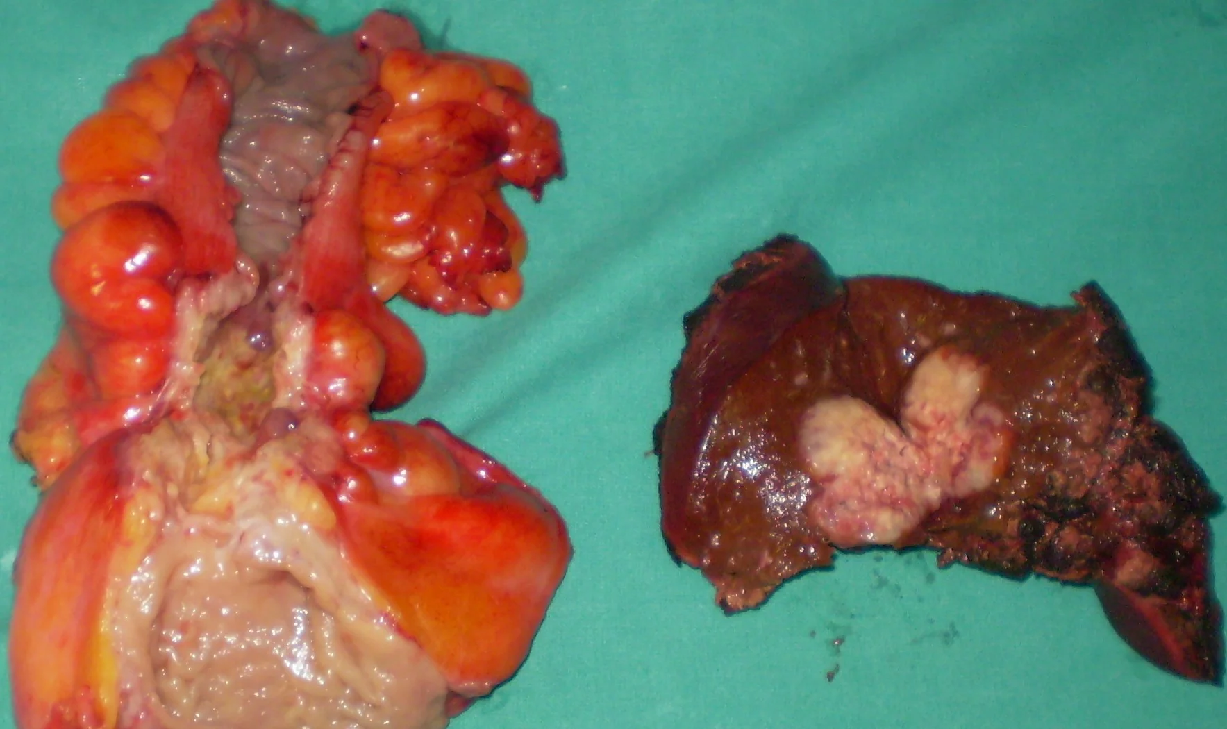 RECTAL CARCINOMA - SOLITARY LIVER METASTASIS