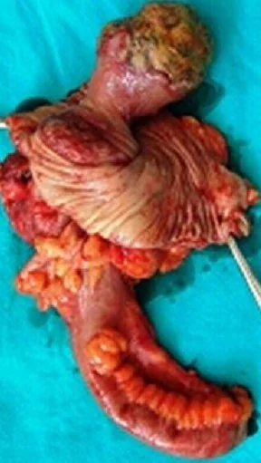 PEDUNCULATED CECAL LIPOMA