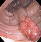 PEDUNCULATED TUBULAR ADENOMA