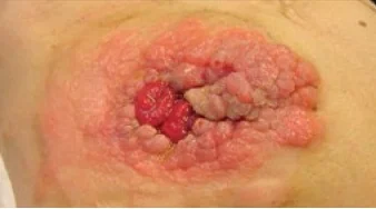 PERISTOMAL TUMOR INFILTRATION